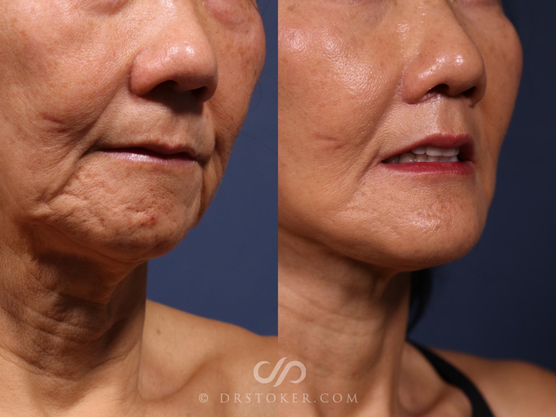 Before & After Lip Lift Case 2624 Right Oblique View in Los Angeles, CA