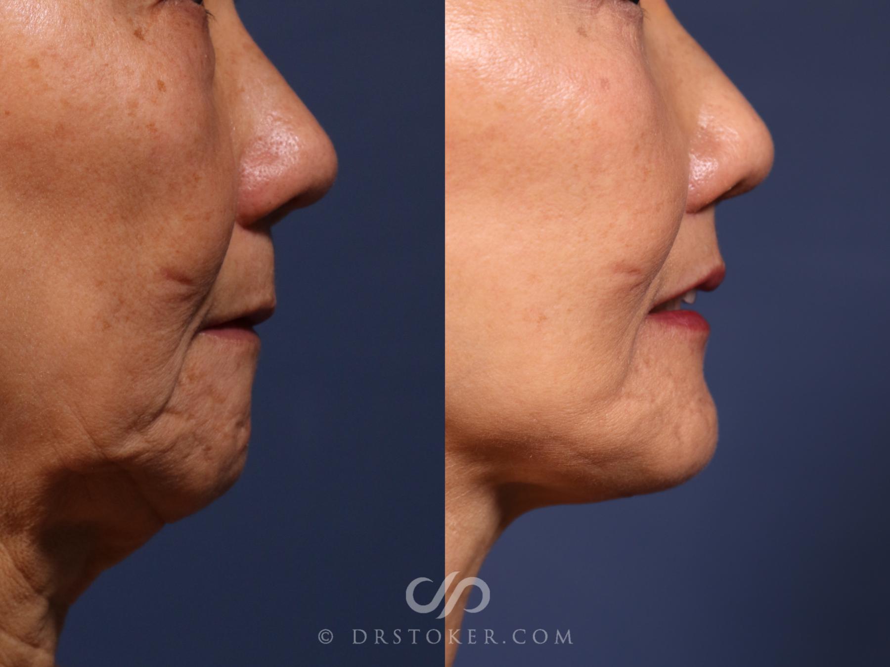 Before & After Lip Lift Case 2624 Right Side View in Los Angeles, CA
