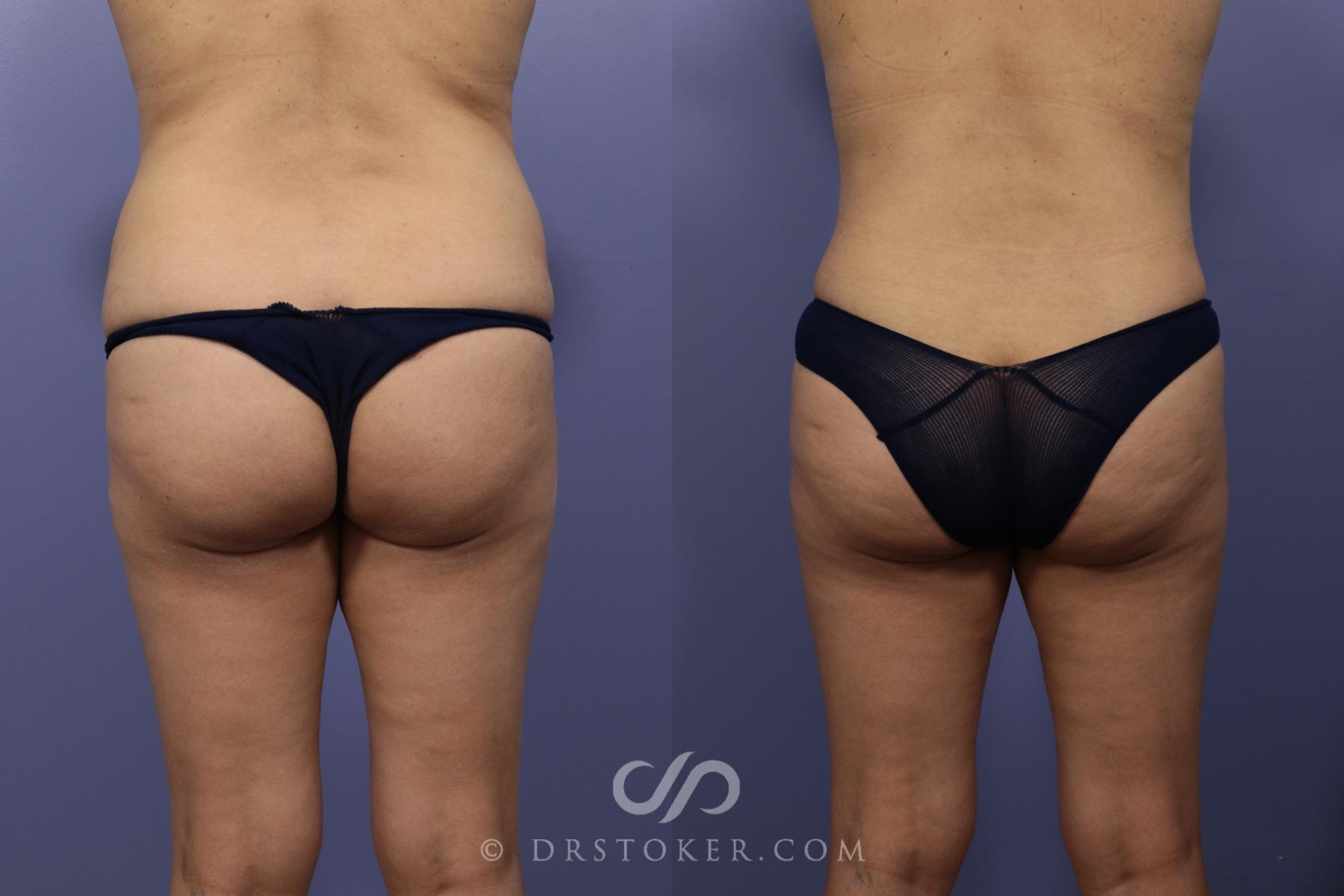Before & After Liposuction Case 1015 View #1 View in Los Angeles, CA