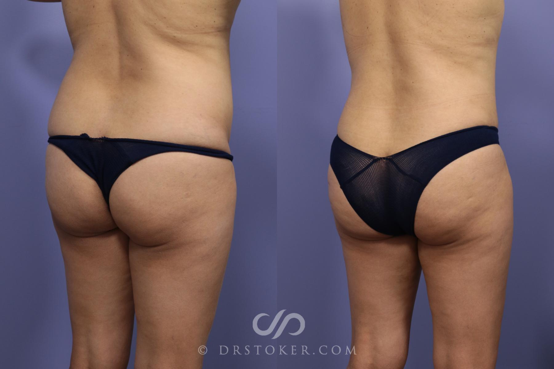 Before & After Liposuction Case 1015 View #2 View in Los Angeles, CA