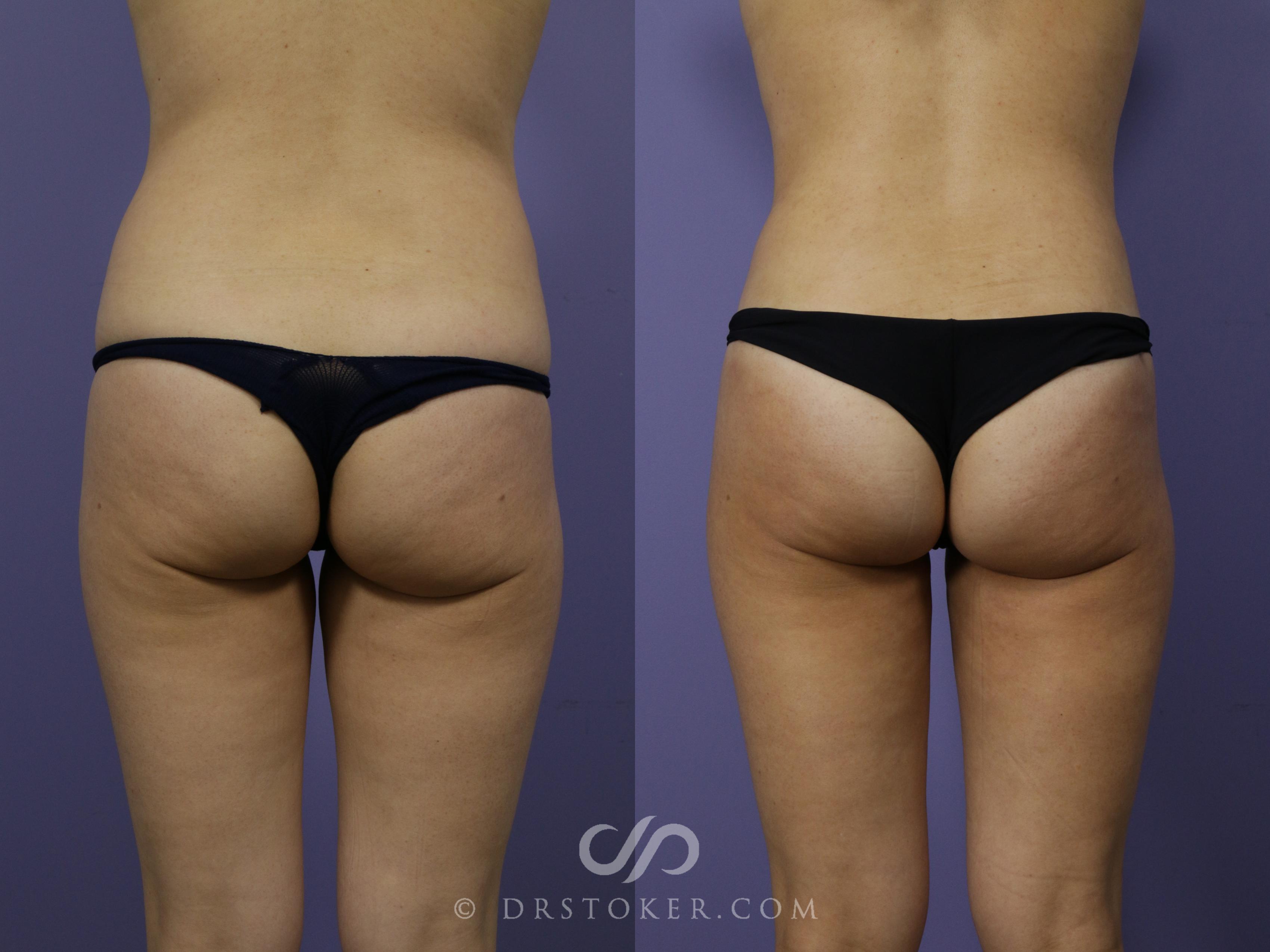 Before & After Liposuction Case 1016 View #1 View in Los Angeles, CA