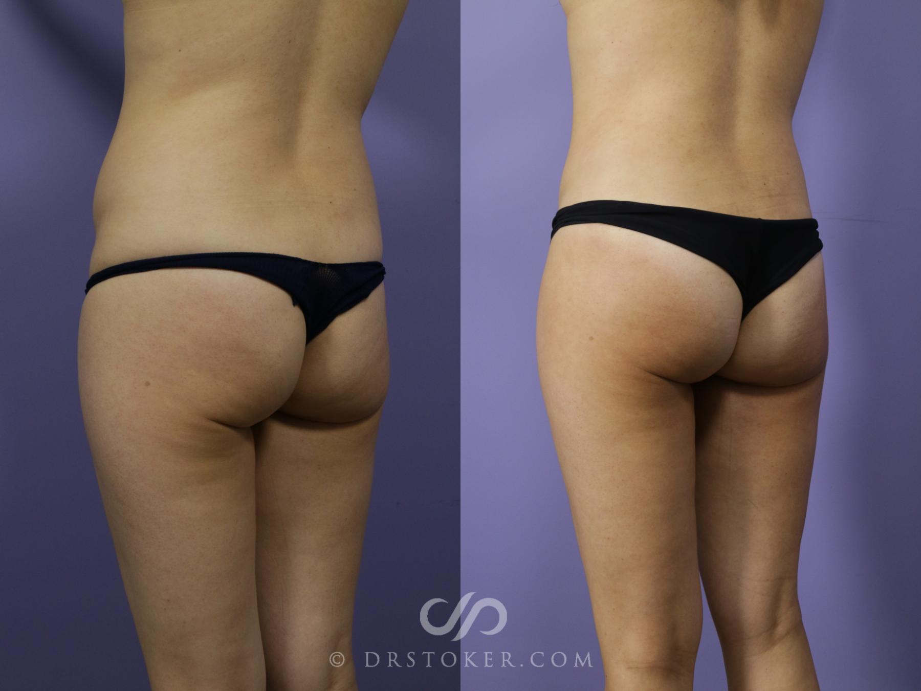 Before & After Liposuction Case 1016 View #2 View in Los Angeles, CA