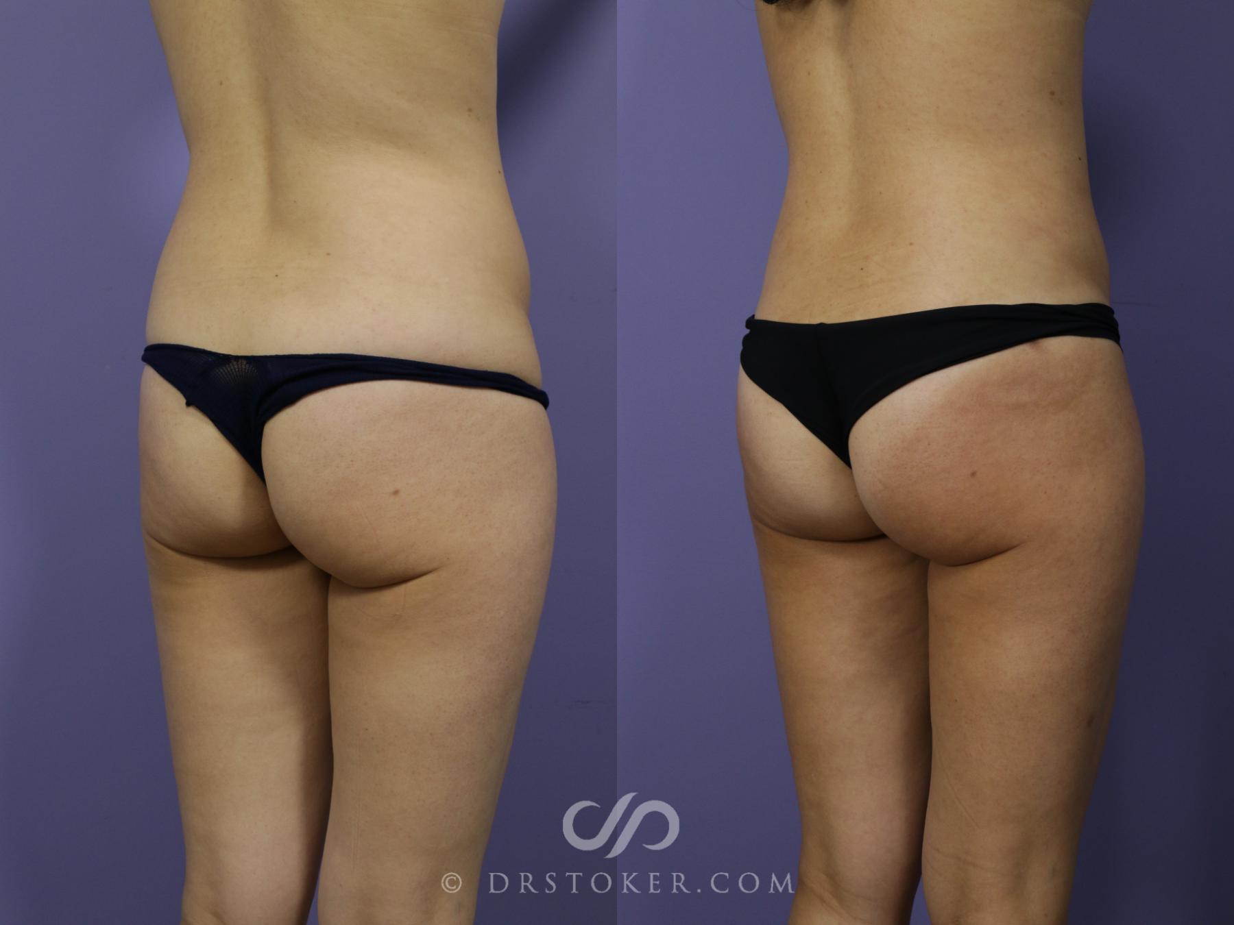 Before & After Liposuction Case 1016 View #3 View in Los Angeles, CA