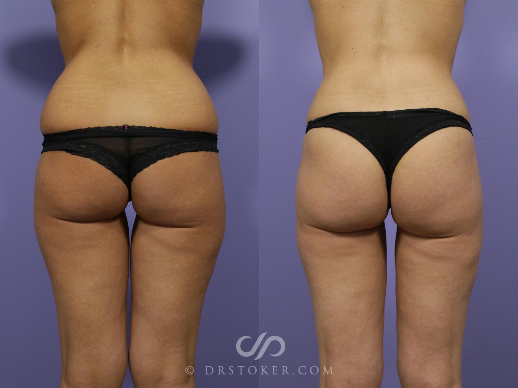 Before & After Liposuction Case 1017 View #1 View in Los Angeles, CA