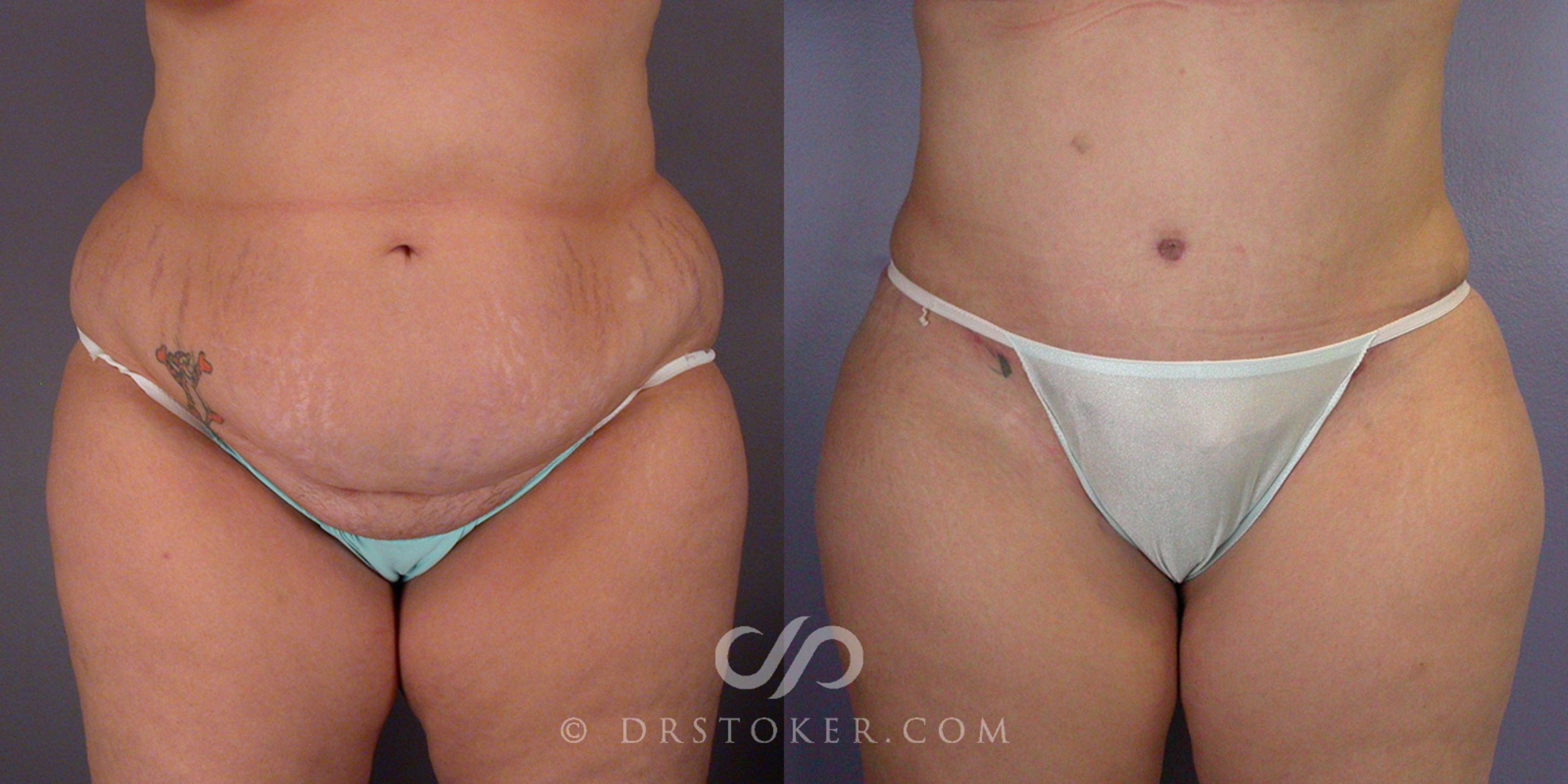 Before & After Tummy Tuck Case 105 View #1 View in Los Angeles, CA