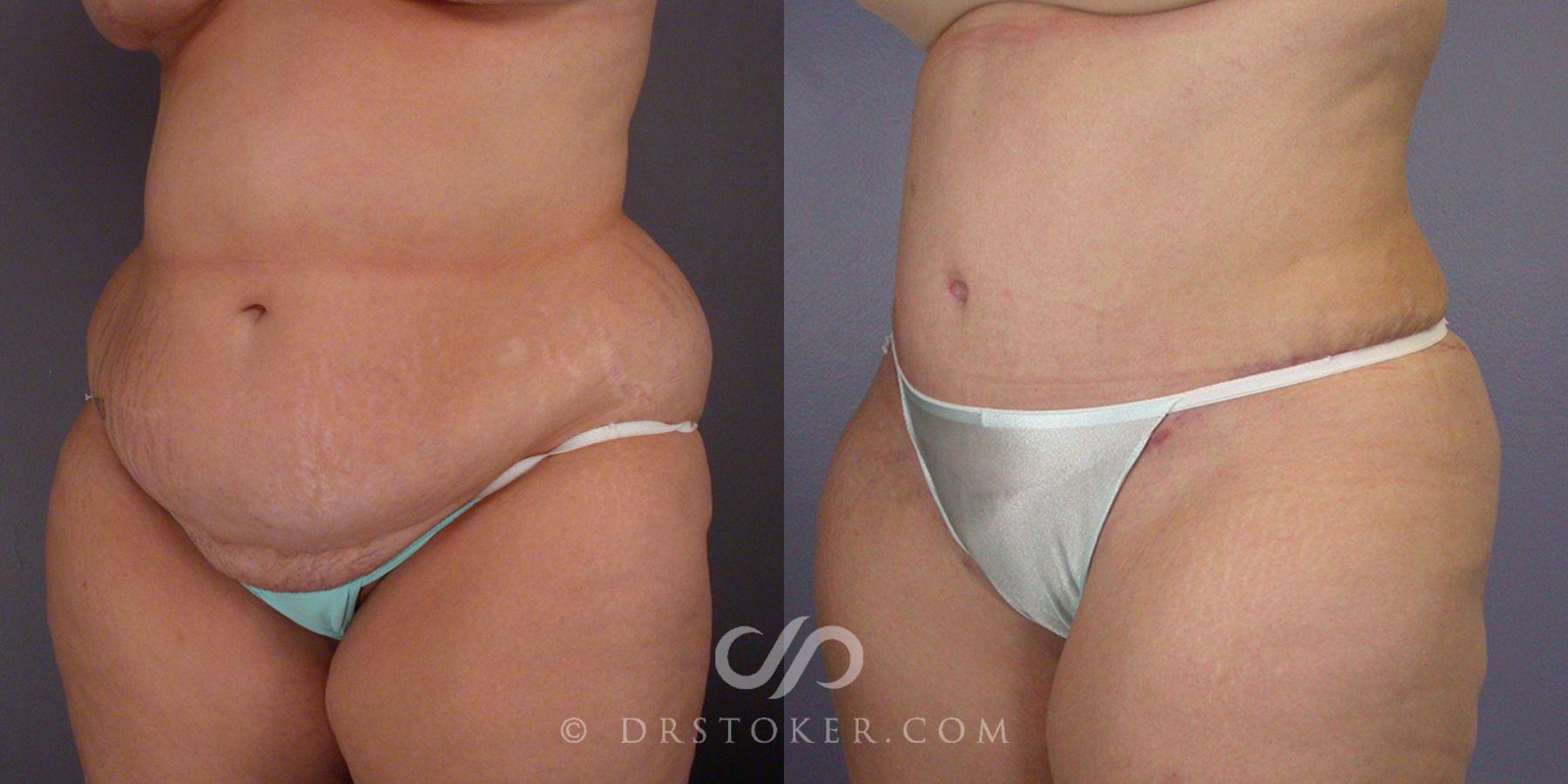 Before & After Tummy Tuck Case 105 View #2 View in Los Angeles, CA