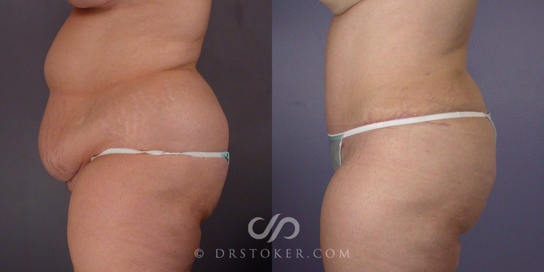 Before & After Liposuction Case 105 View #3 View in Los Angeles, CA
