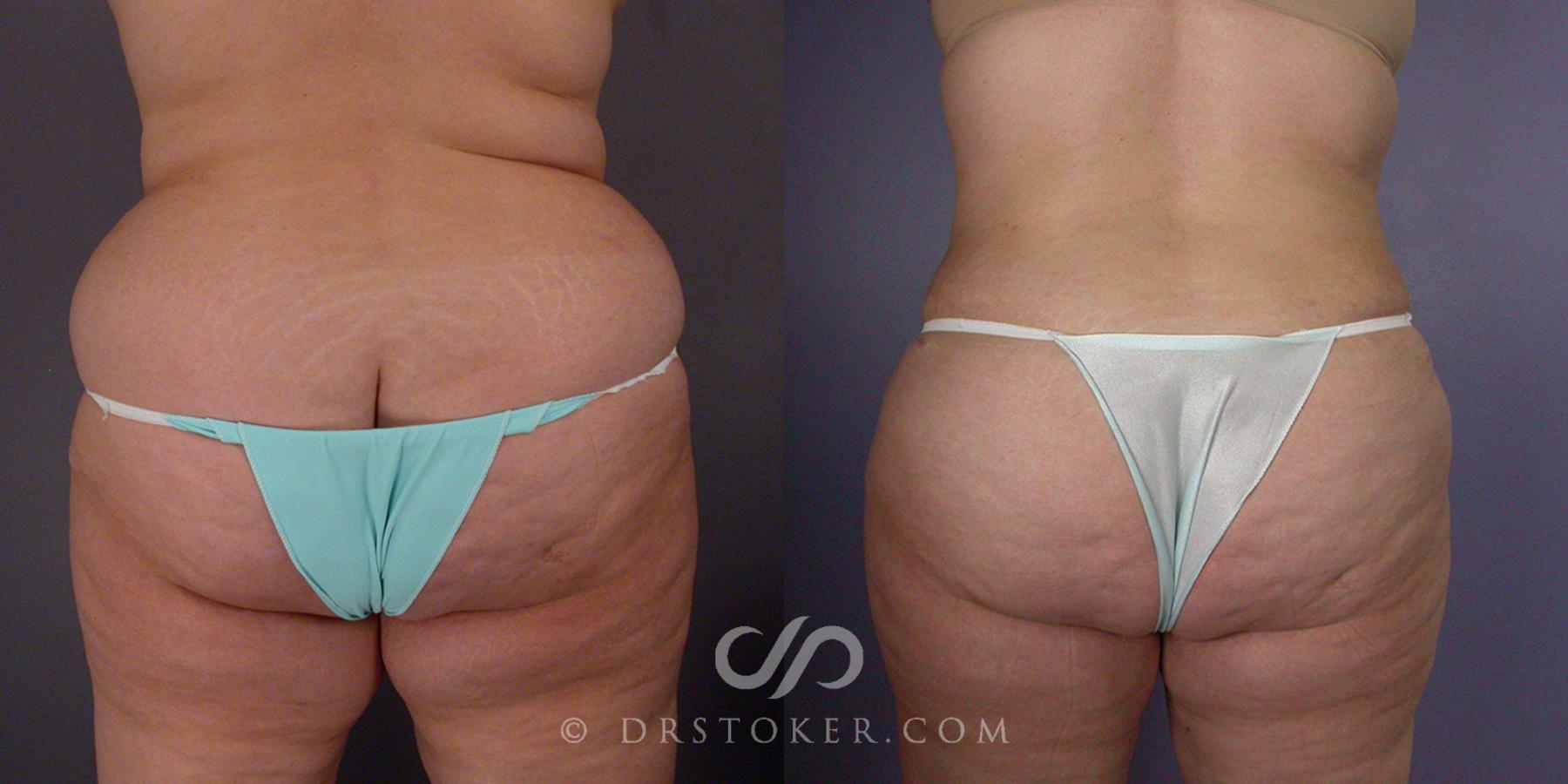 Before & After After Weight Loss Case 105 View #4 View in Los Angeles, CA