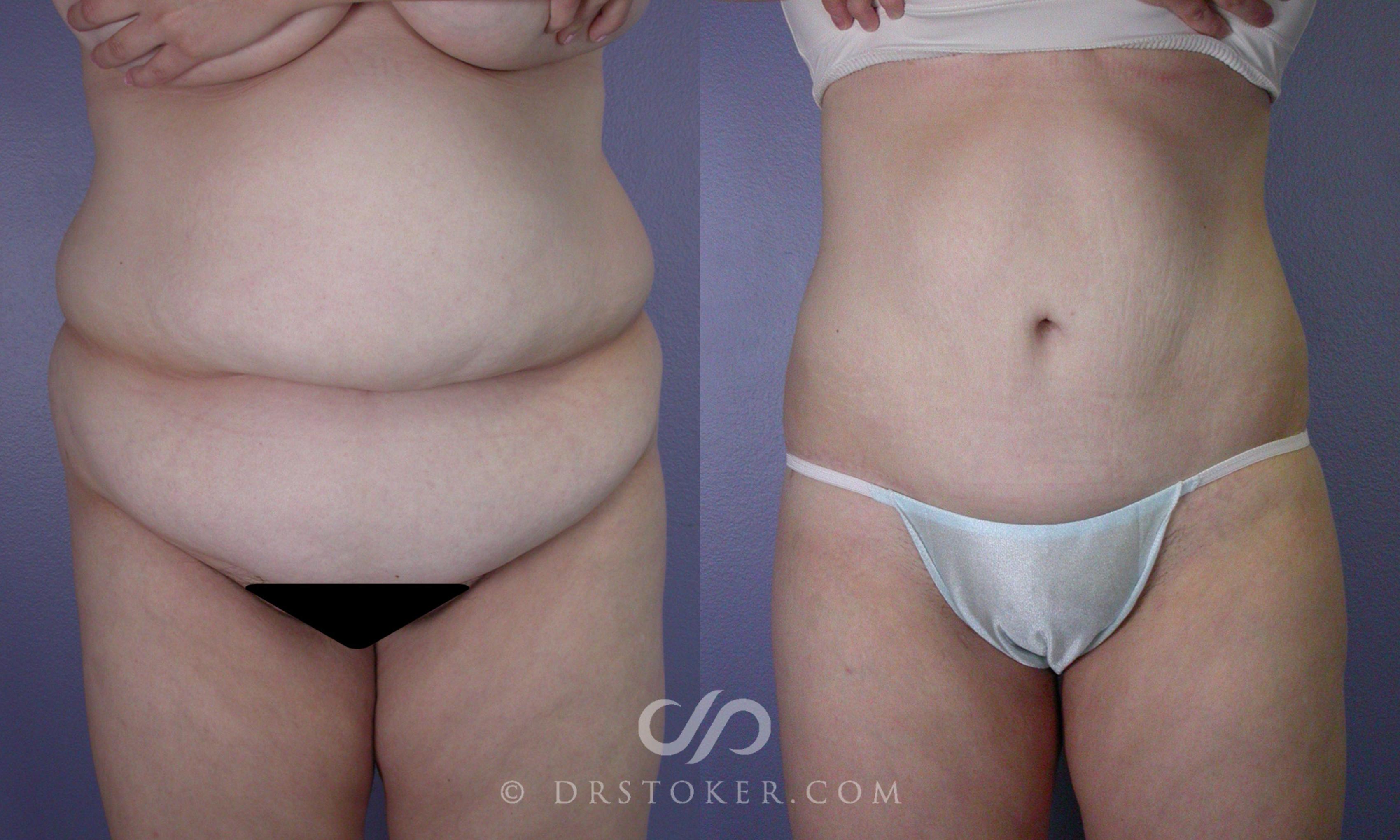 Before & After Tummy Tuck Case 106 View #1 View in Los Angeles, CA