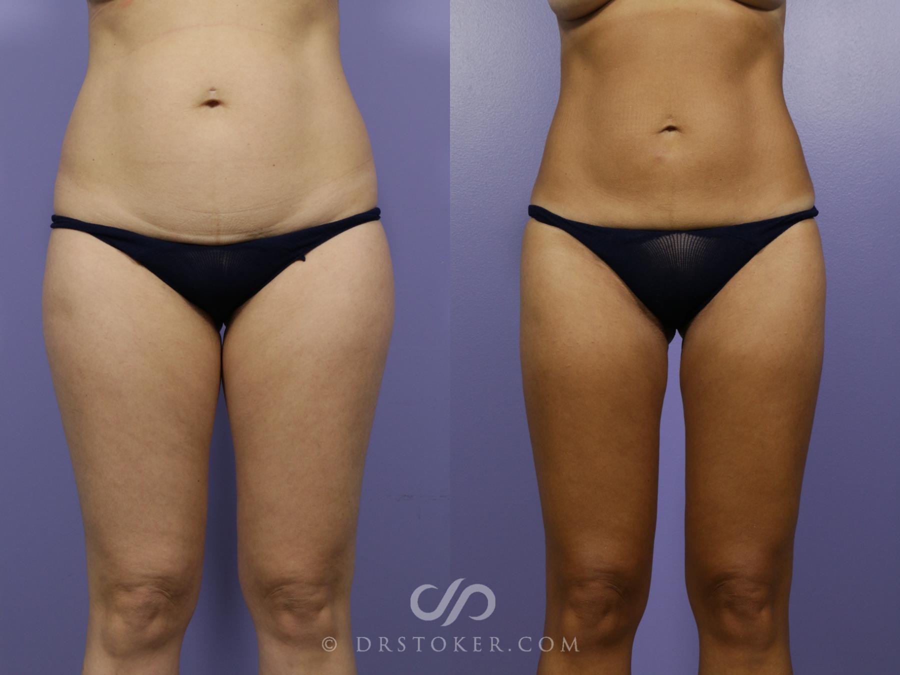 Before & After Liposuction Case 1067 View #1 View in Los Angeles, CA