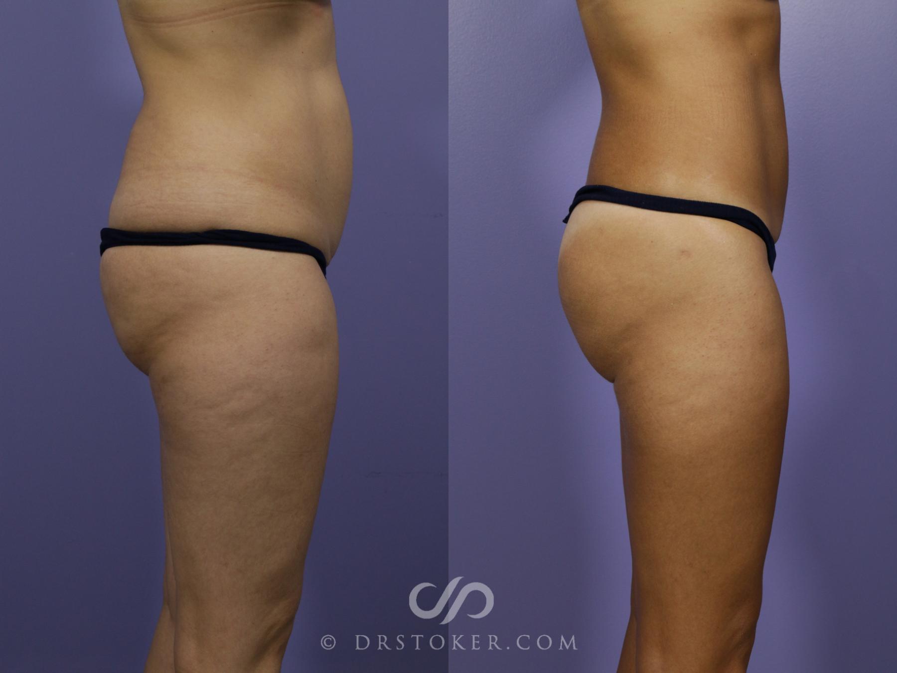 Before & After Liposuction Case 1067 View #2 View in Los Angeles, CA
