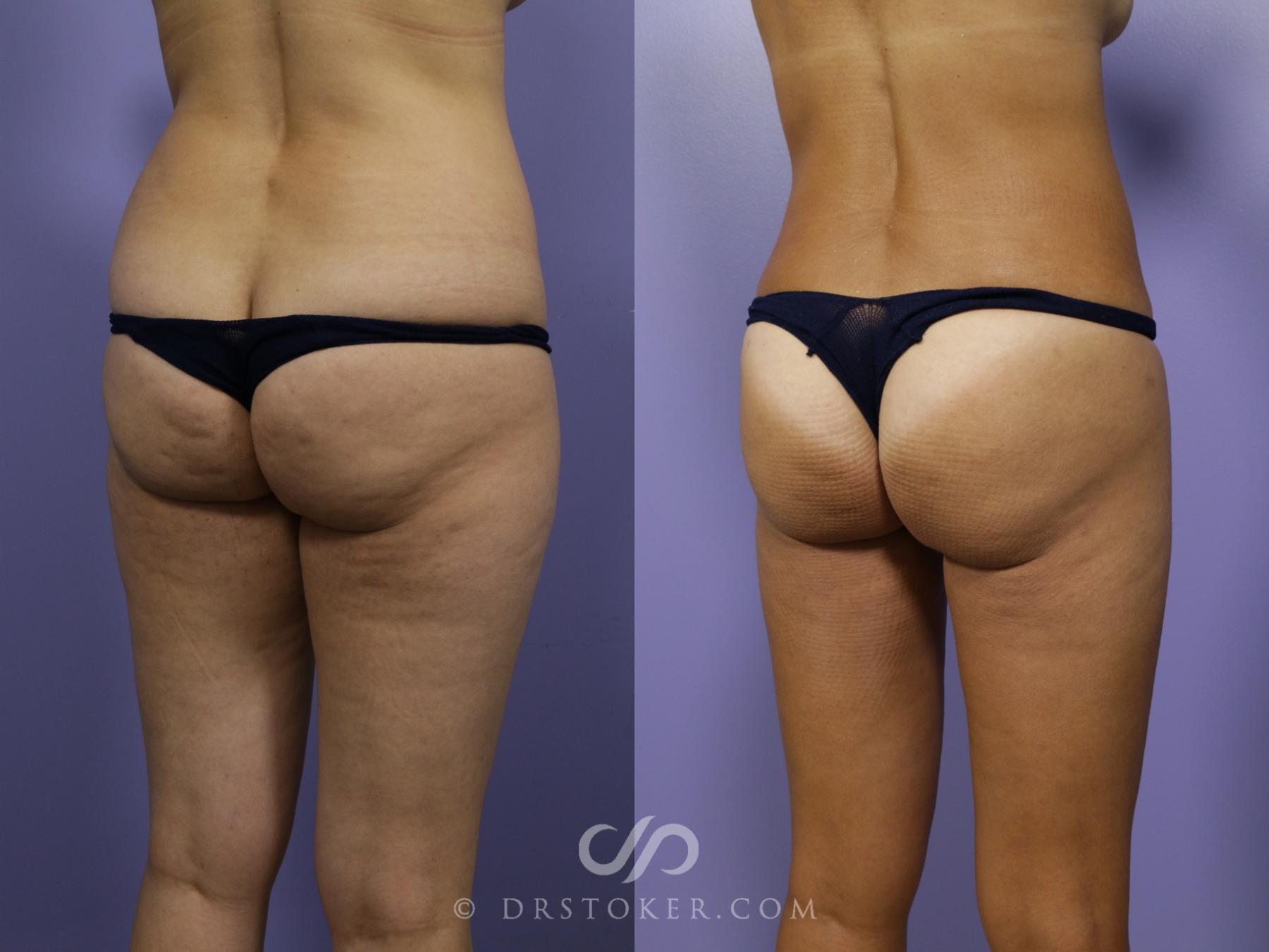 Before & After Liposuction Case 1068 View #1 View in Los Angeles, CA