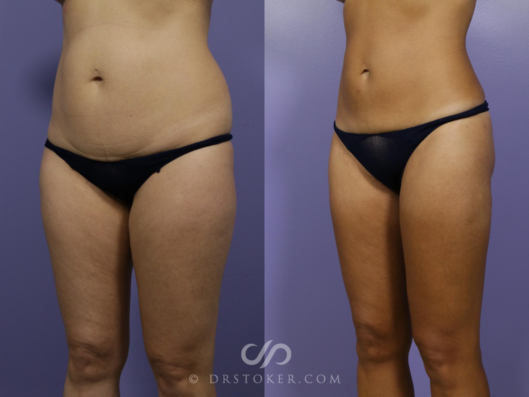 Before & After Liposuction Case 1068 View #2 View in Los Angeles, CA