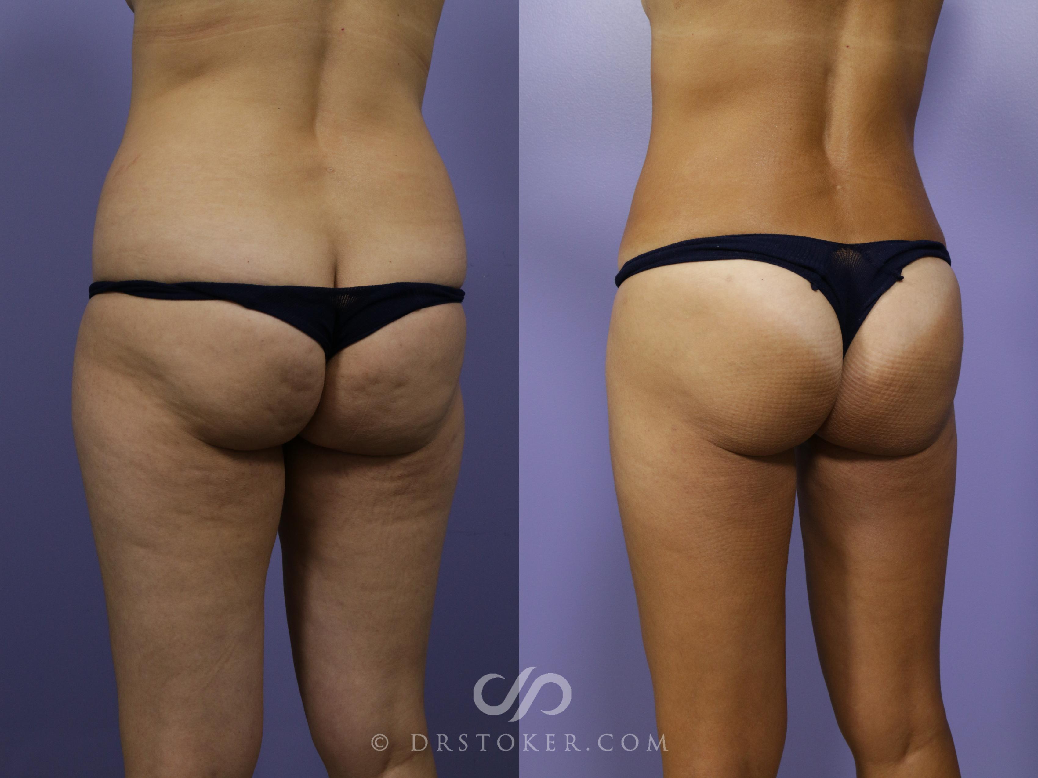 Before & After Liposuction Case 1070 View #1 View in Los Angeles, CA