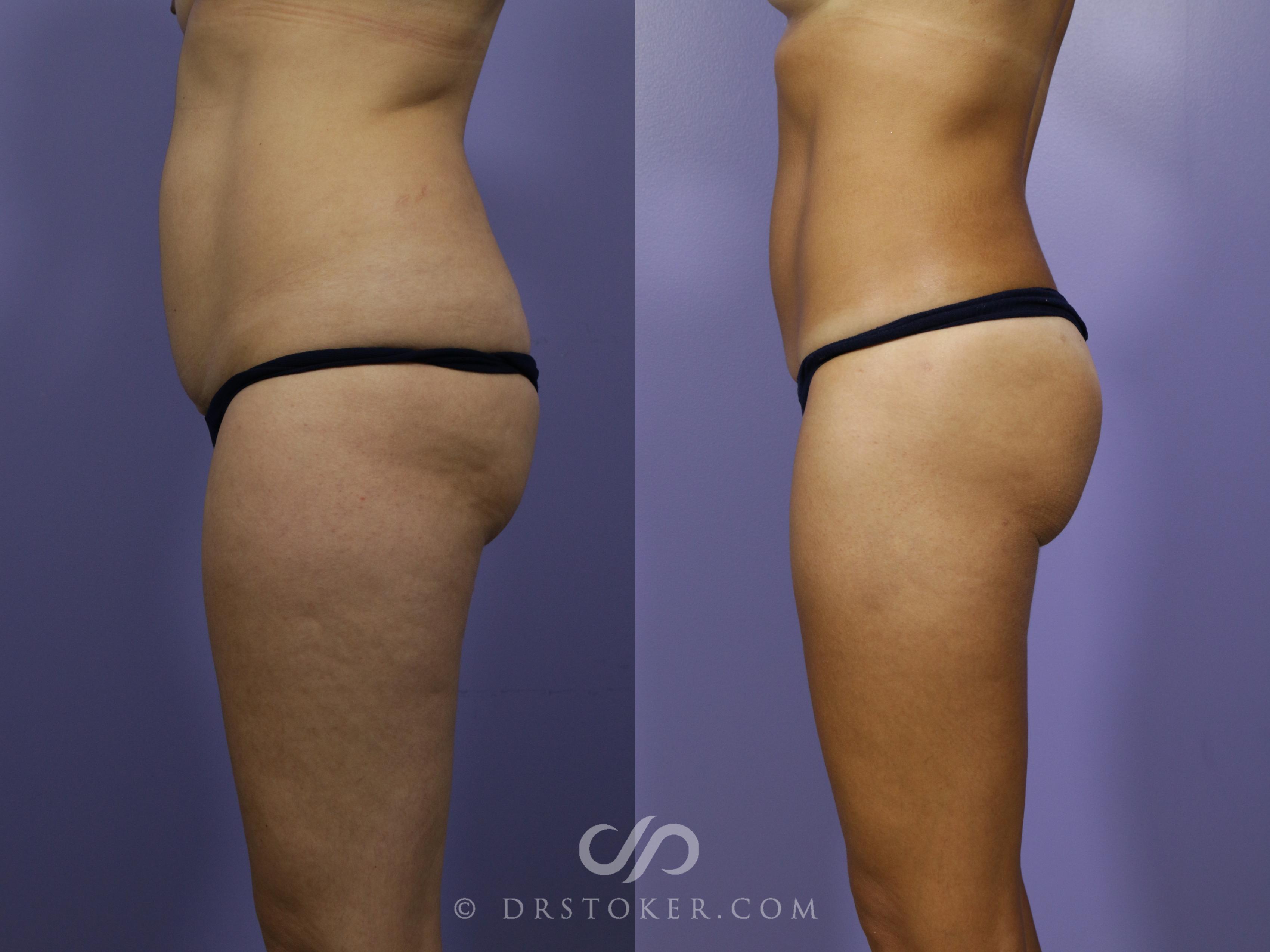 Before & After Liposuction Case 1071 View #1 View in Los Angeles, CA