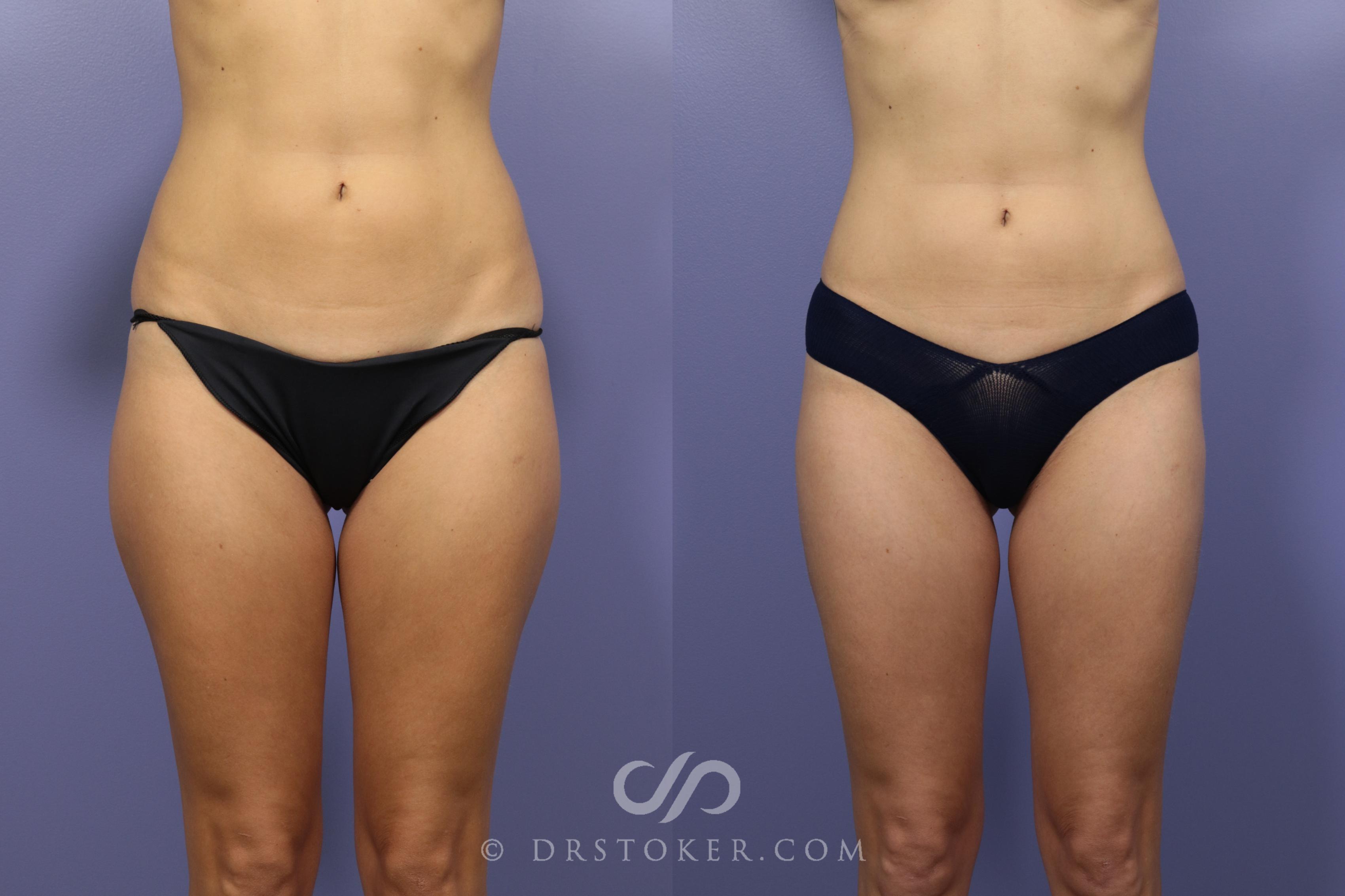 Before & After Liposuction Case 1072 View #1 View in Los Angeles, CA