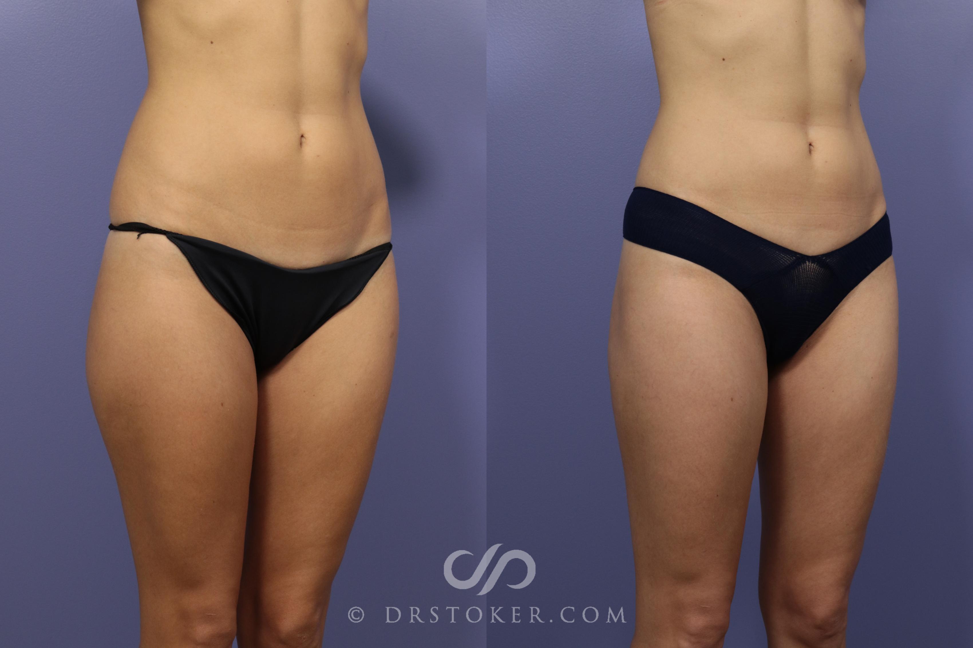 Before & After Liposuction Case 1072 View #2 View in Los Angeles, CA