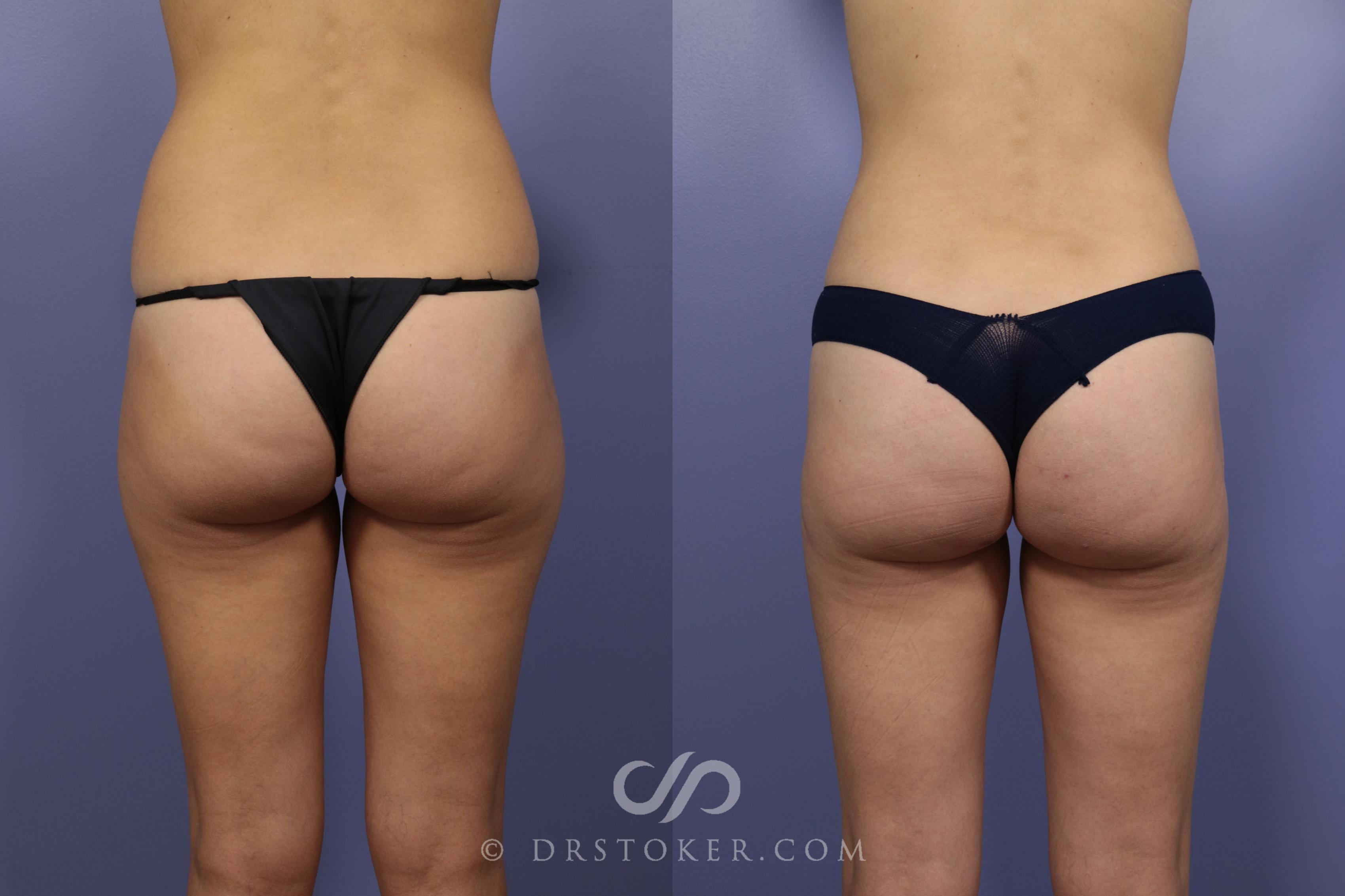 Before & After Liposuction Case 1073 View #1 View in Los Angeles, CA