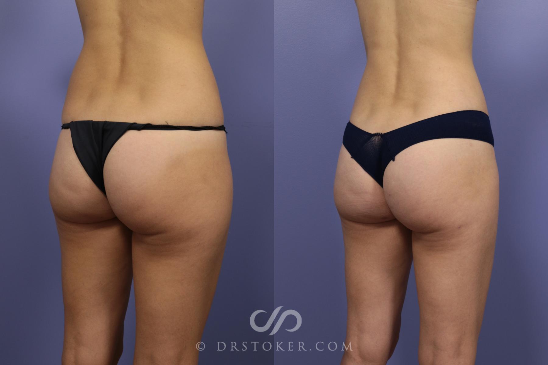 Before & After Liposuction Case 1073 View #2 View in Los Angeles, CA