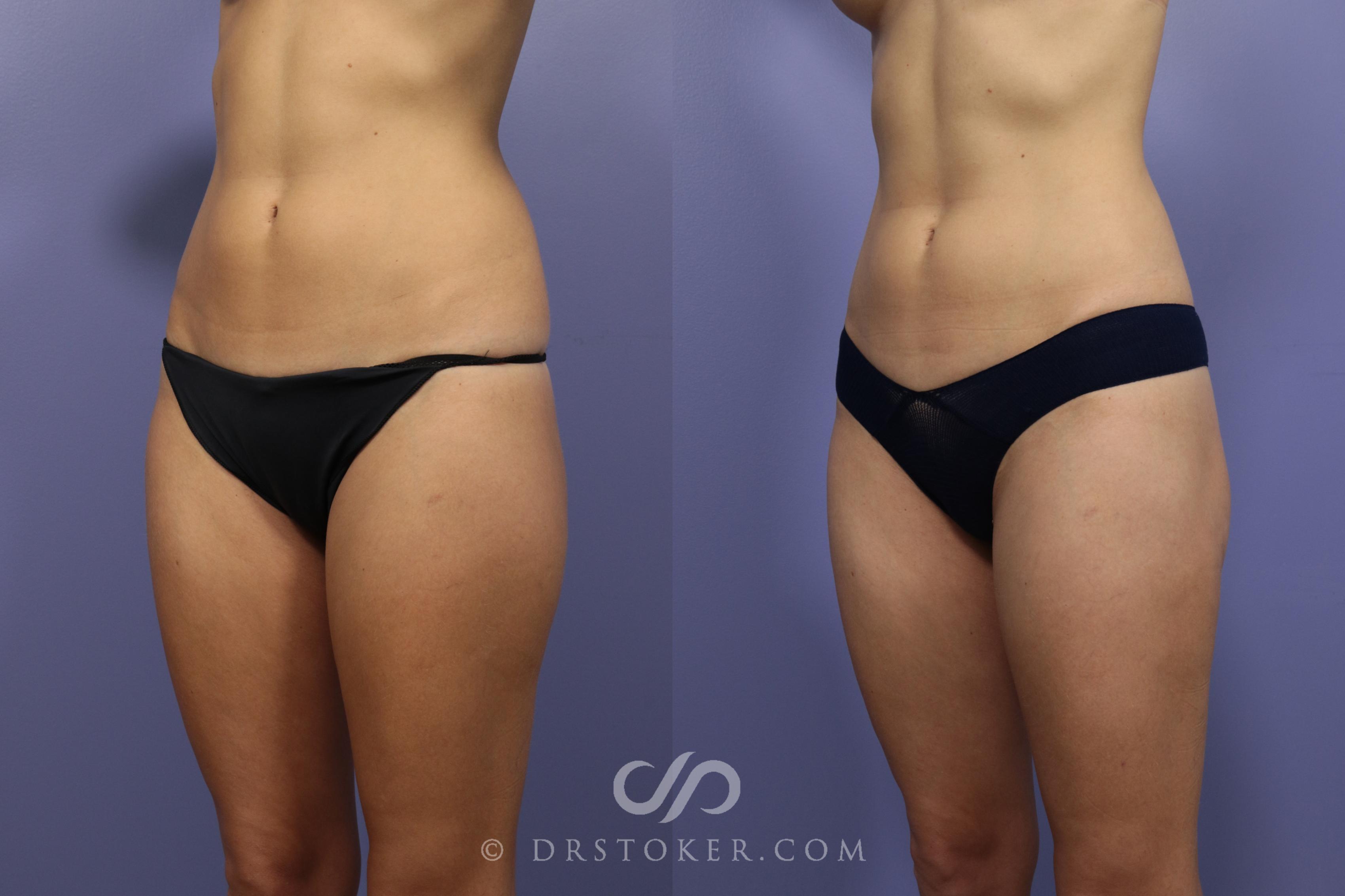 Before & After Liposuction Case 1074 View #1 View in Los Angeles, CA