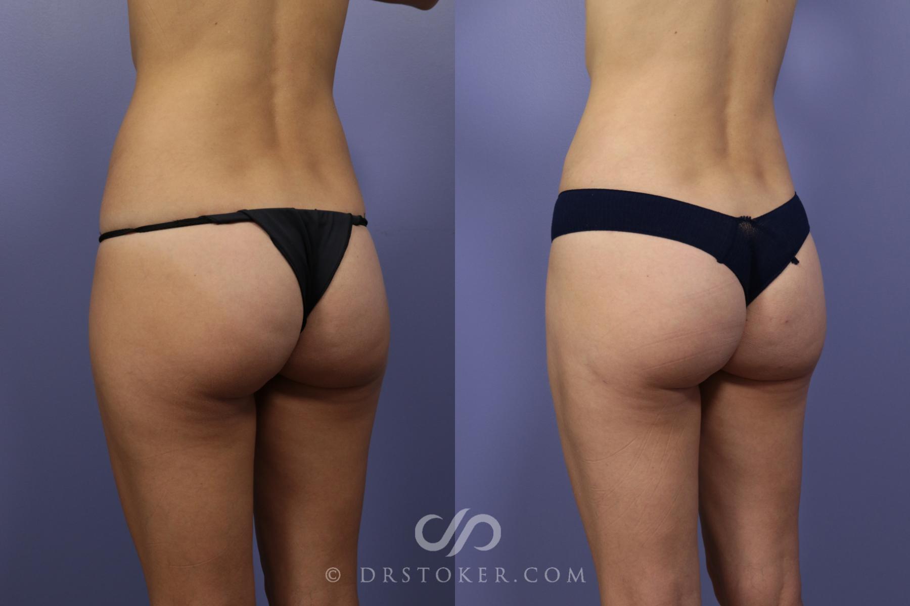 Before & After Liposuction Case 1074 View #2 View in Los Angeles, CA