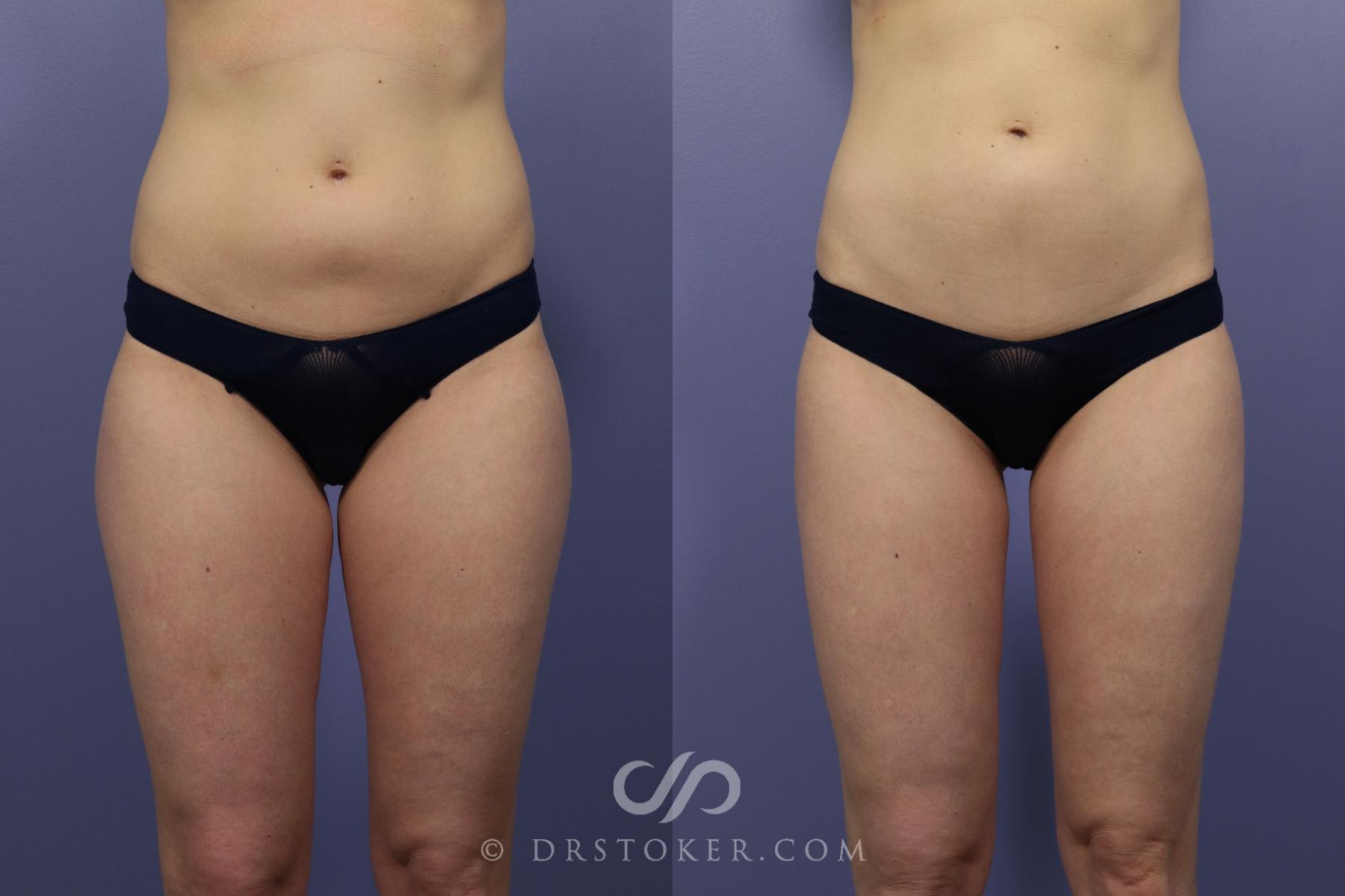 Before & After Liposuction Case 1075 View #1 View in Los Angeles, CA