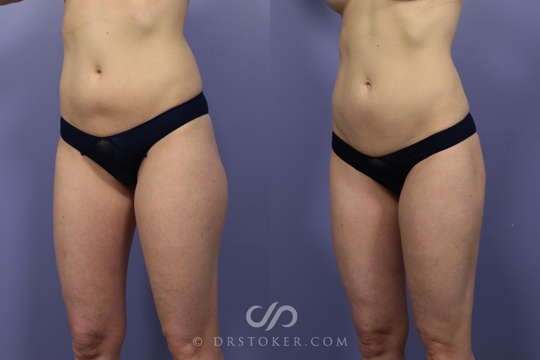 Before & After Liposuction Case 1075 View #2 View in Los Angeles, CA