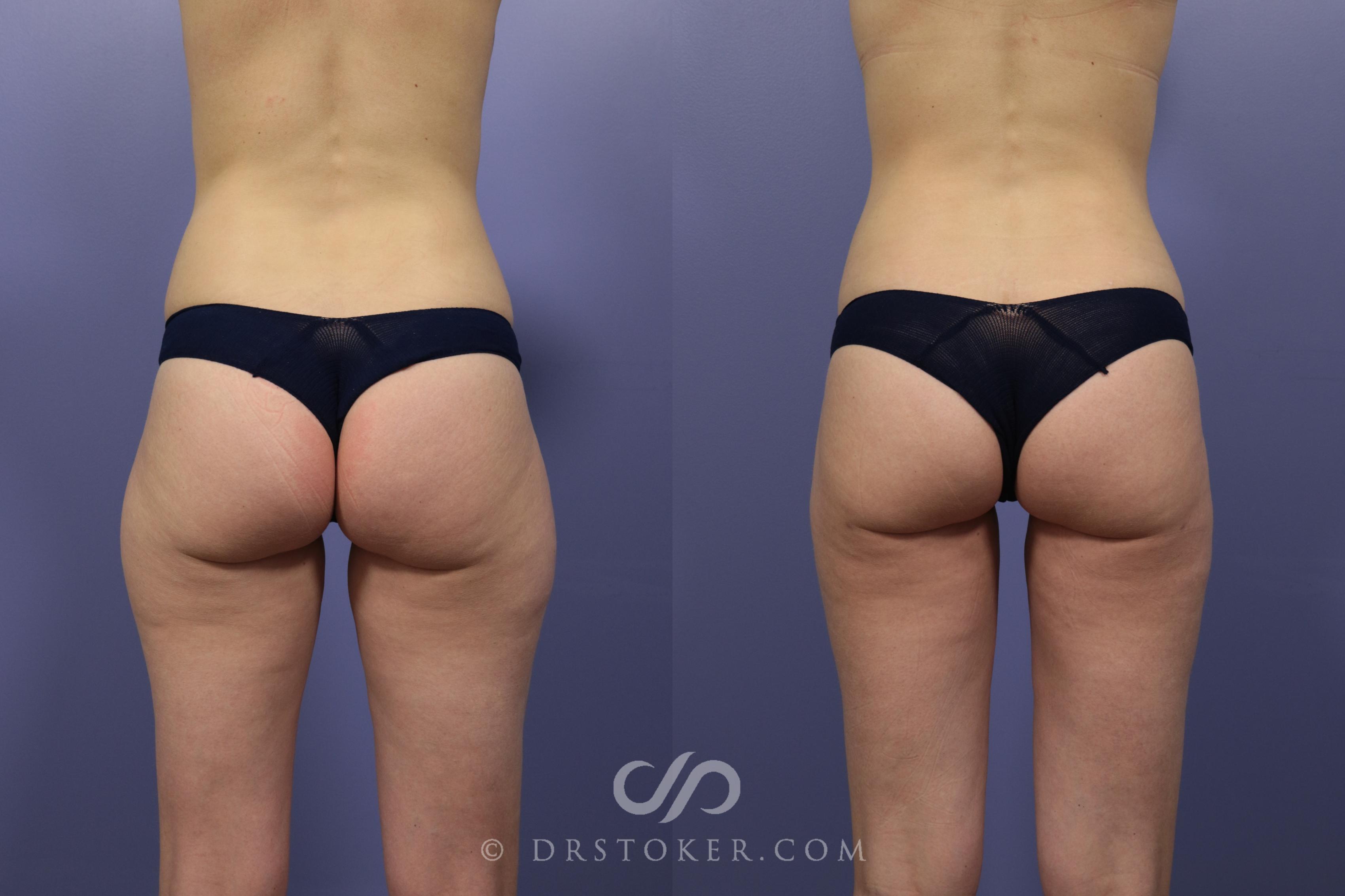 Before & After Liposuction Case 1076 View #1 View in Los Angeles, CA