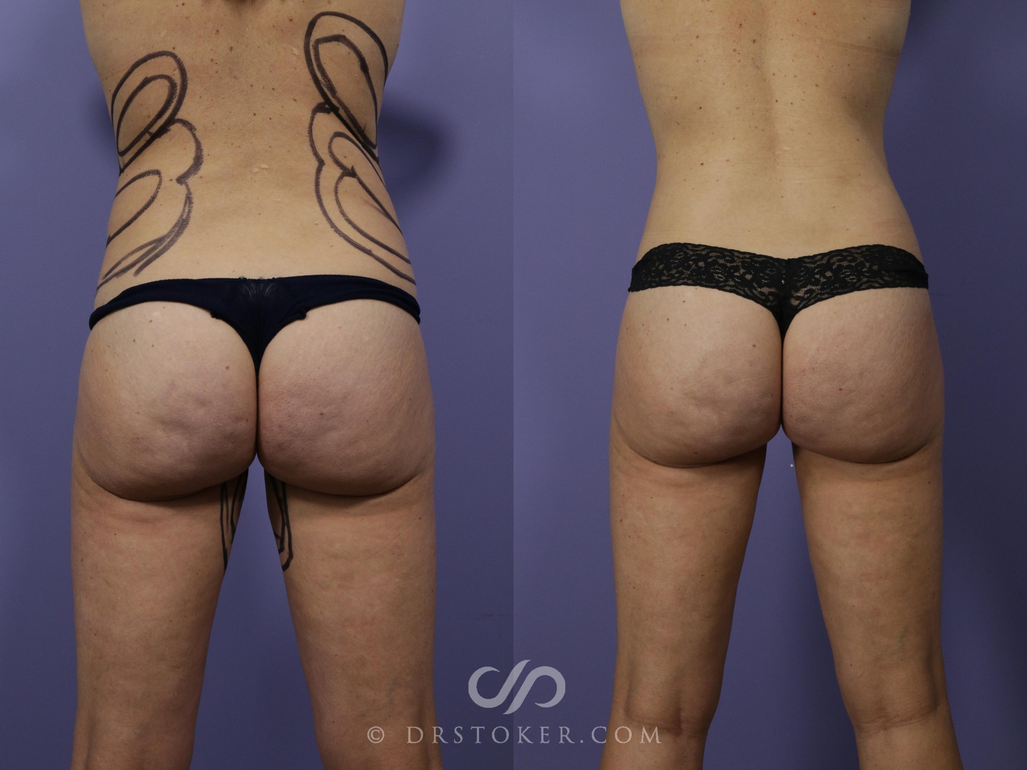 Before & After Liposuction Case 1077 View #1 View in Los Angeles, CA