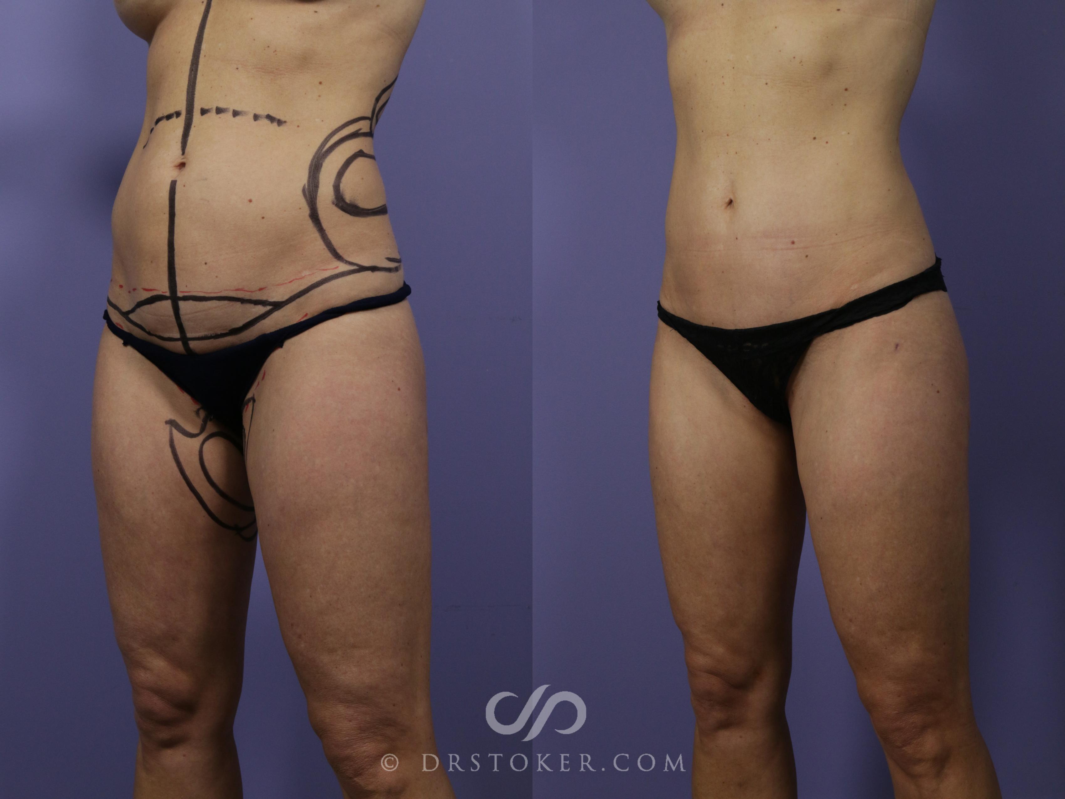 Before & After Liposuction Case 1078 View #1 View in Los Angeles, CA