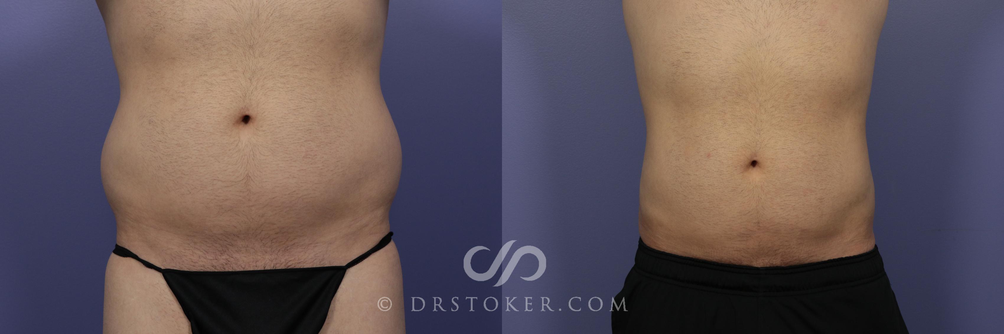 Before & After Liposuction for Men Case 1079 View #1 View in Los Angeles, CA