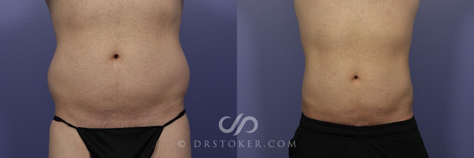 Before & After Liposuction for Men Case 1079 View #1 View in Los Angeles, CA