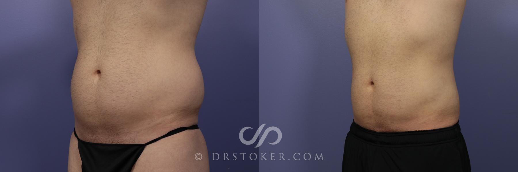 Before & After Liposuction for Men Case 1079 View #2 View in Los Angeles, CA