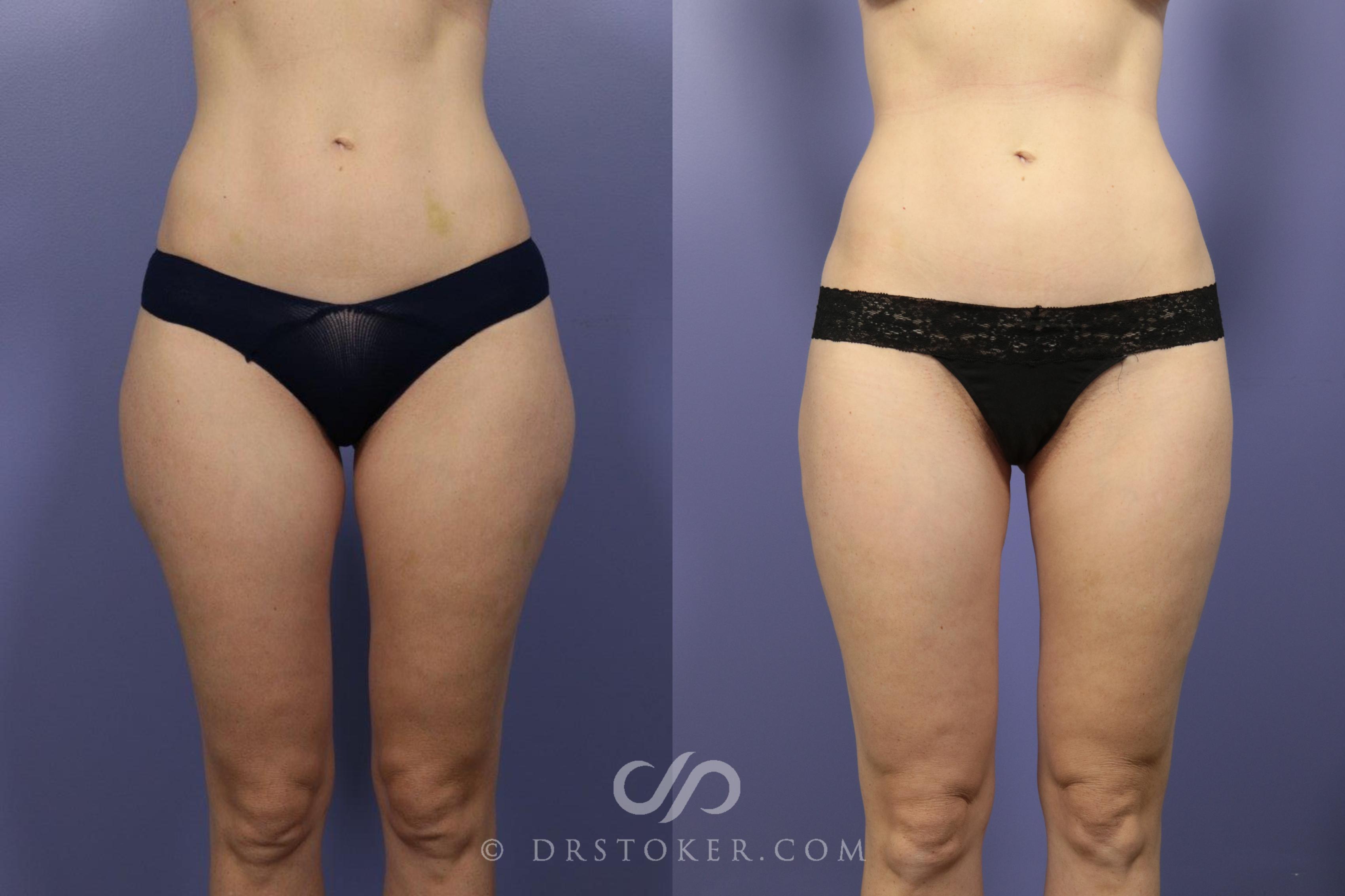 Before & After Liposuction Case 1080 View #1 View in Los Angeles, CA