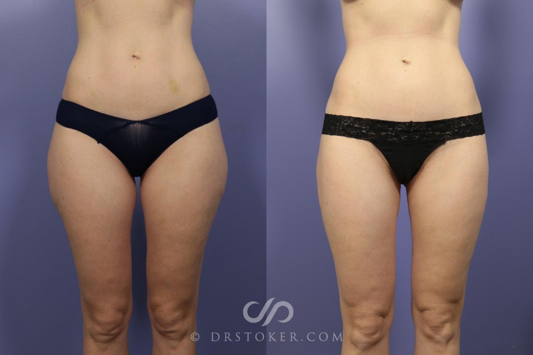 Before & After Liposuction Case 1080 View #1 View in Los Angeles, CA