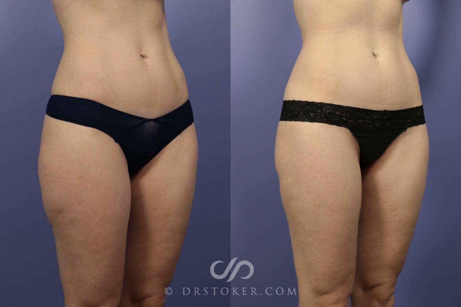 Before & After Liposuction Case 1080 View #2 View in Los Angeles, CA