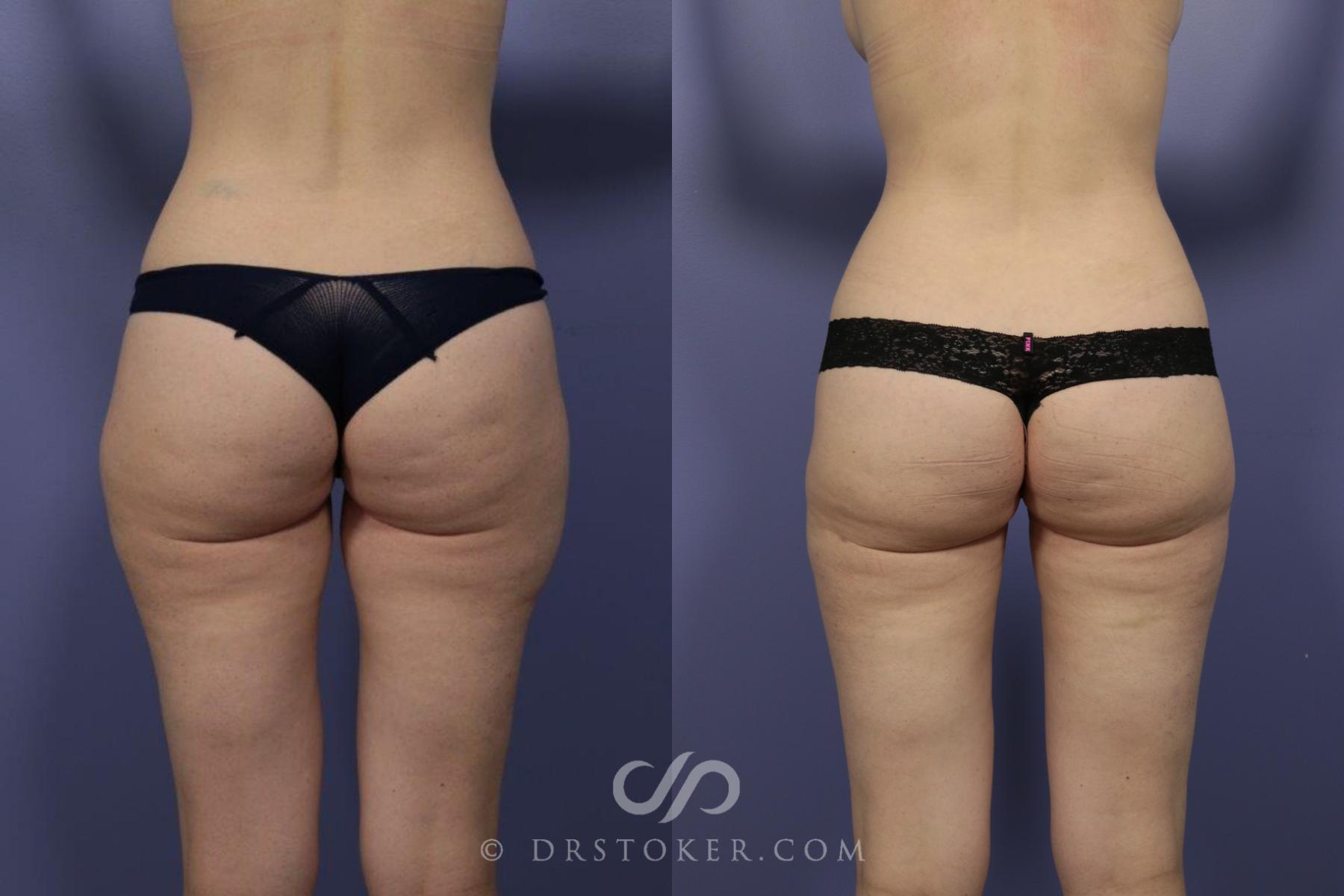 Before & After Liposuction Case 1080 View #3 View in Los Angeles, CA