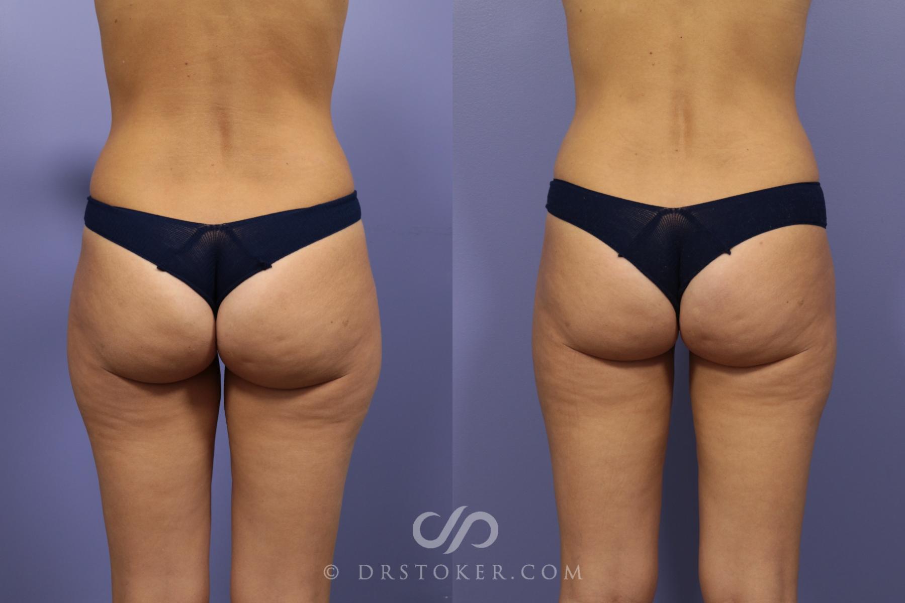 Before & After Liposuction Case 1081 View #1 View in Los Angeles, CA