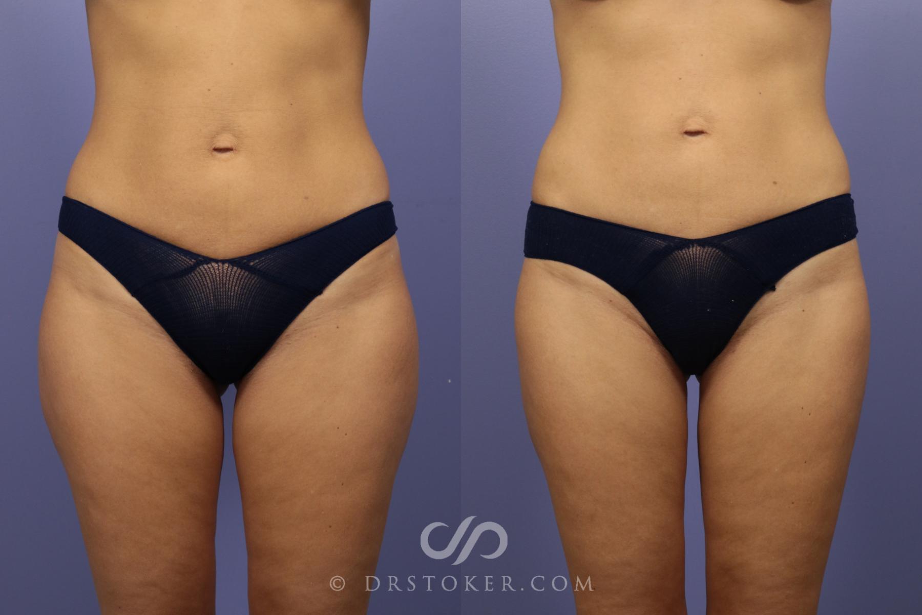 Before & After Liposuction Case 1081 View #2 View in Los Angeles, CA
