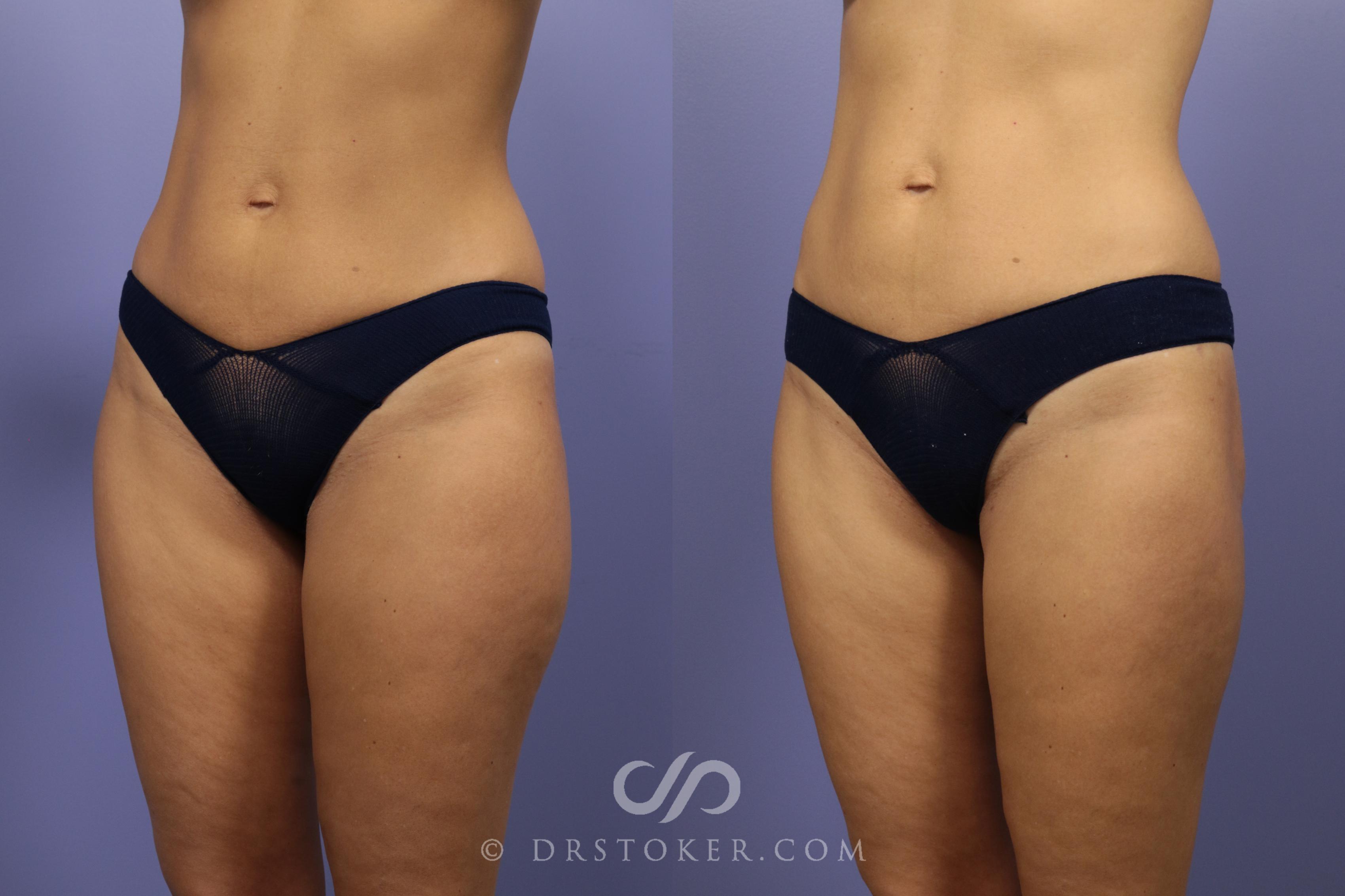 Before & After Liposuction Case 1081 View #3 View in Los Angeles, CA