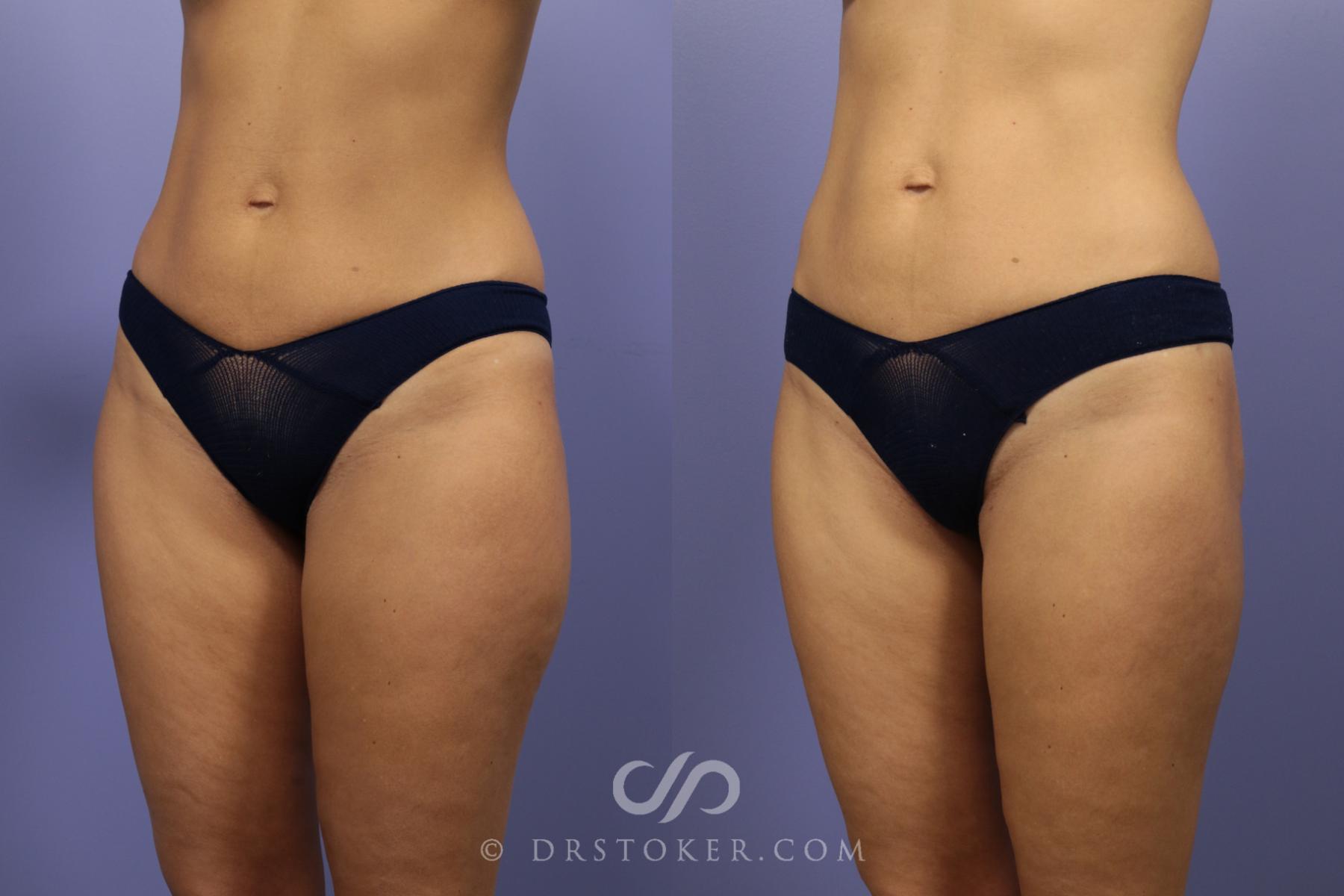 Before & After Liposuction Case 1081 View #3 View in Los Angeles, CA