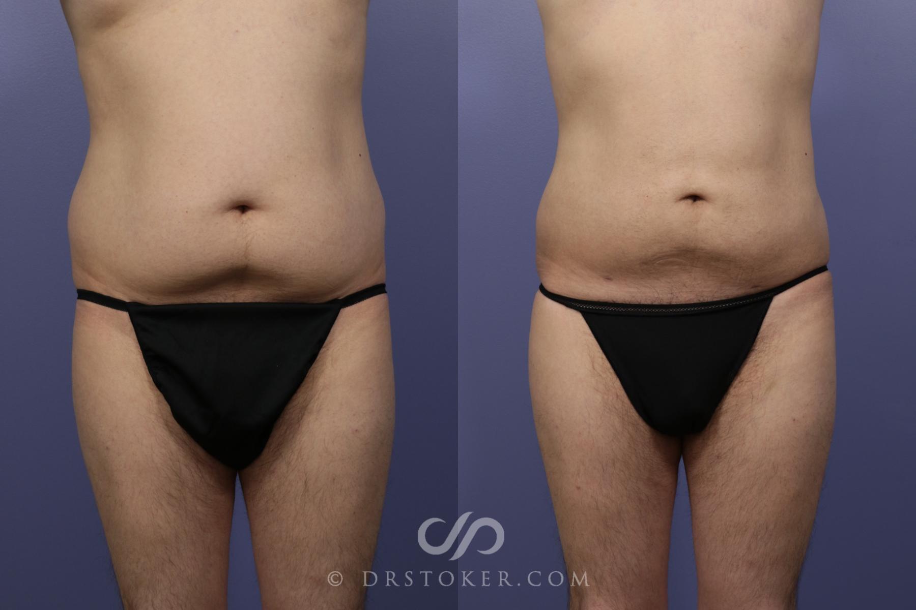 Before & After Liposuction Case 1083 View #1 View in Los Angeles, CA