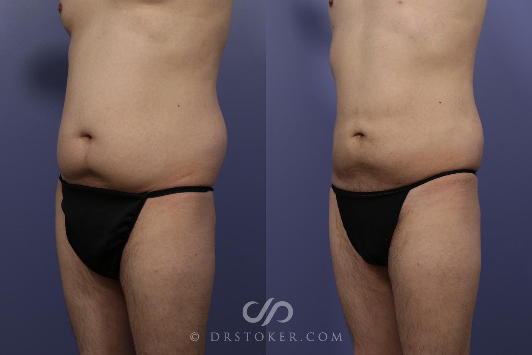Before & After Liposuction Case 1083 View #2 View in Los Angeles, CA