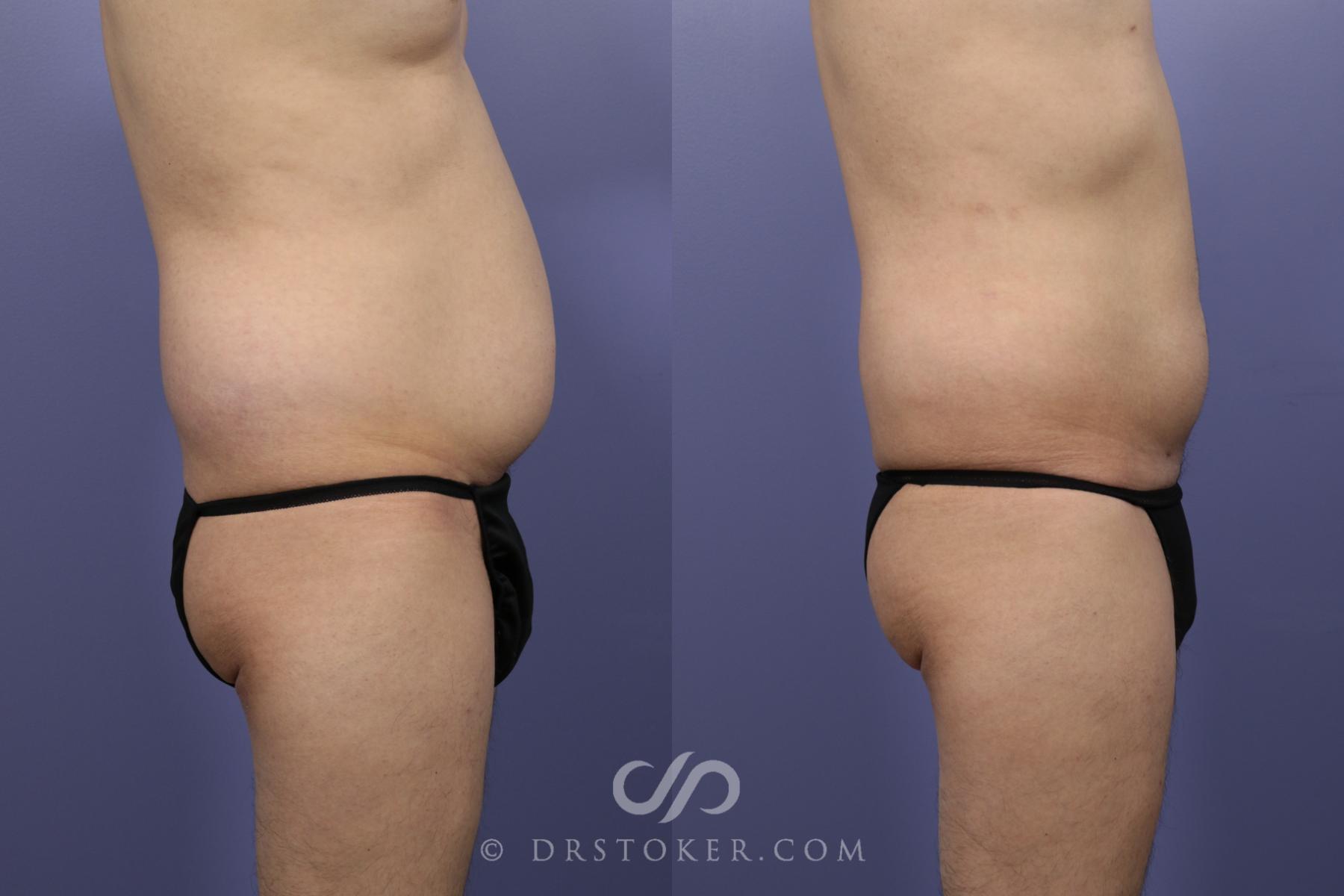 Before & After Liposuction Case 1083 View #3 View in Los Angeles, CA