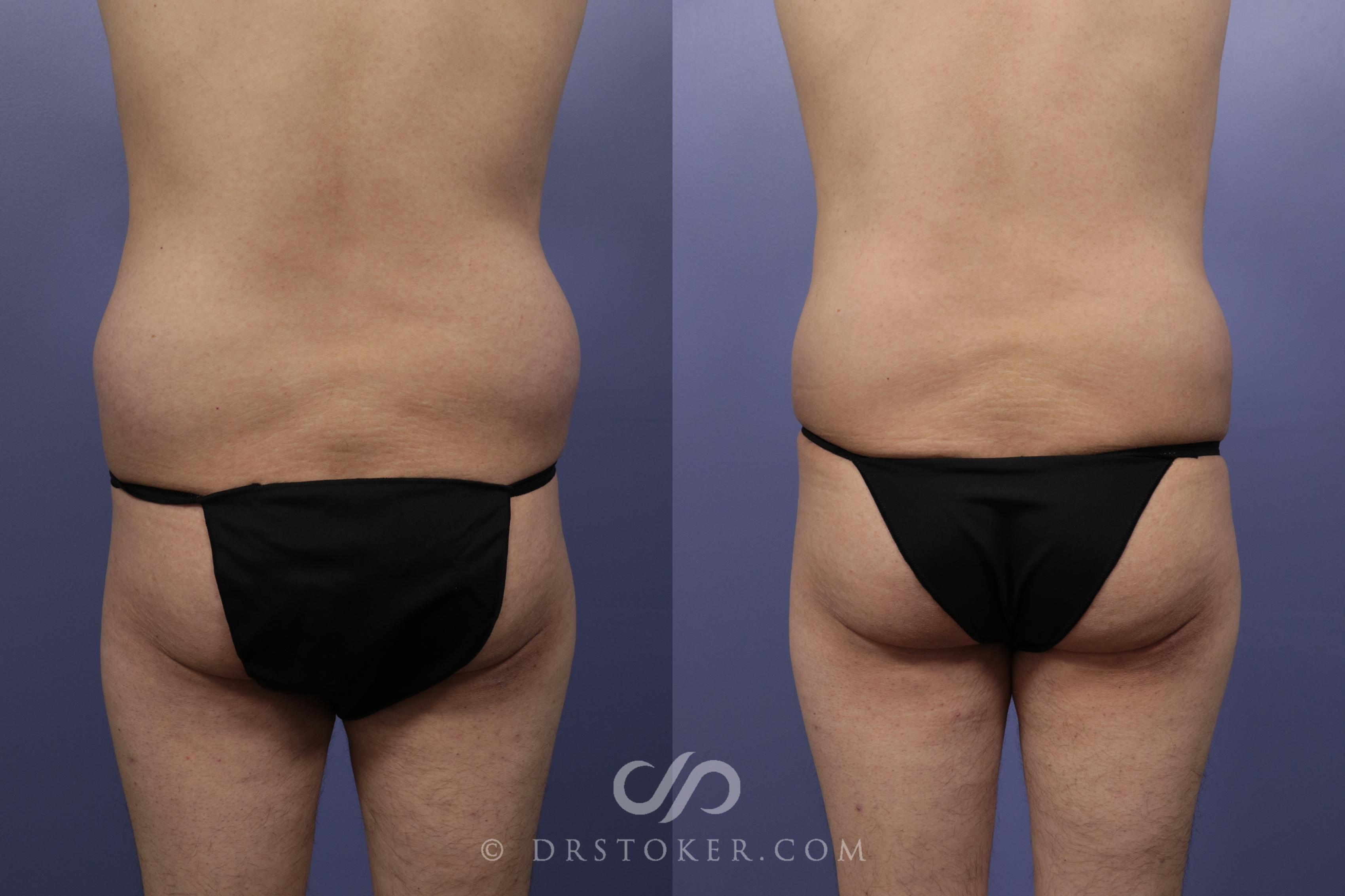 Before & After Liposuction for Men Case 1084 View #1 View in Marina del Rey, CA