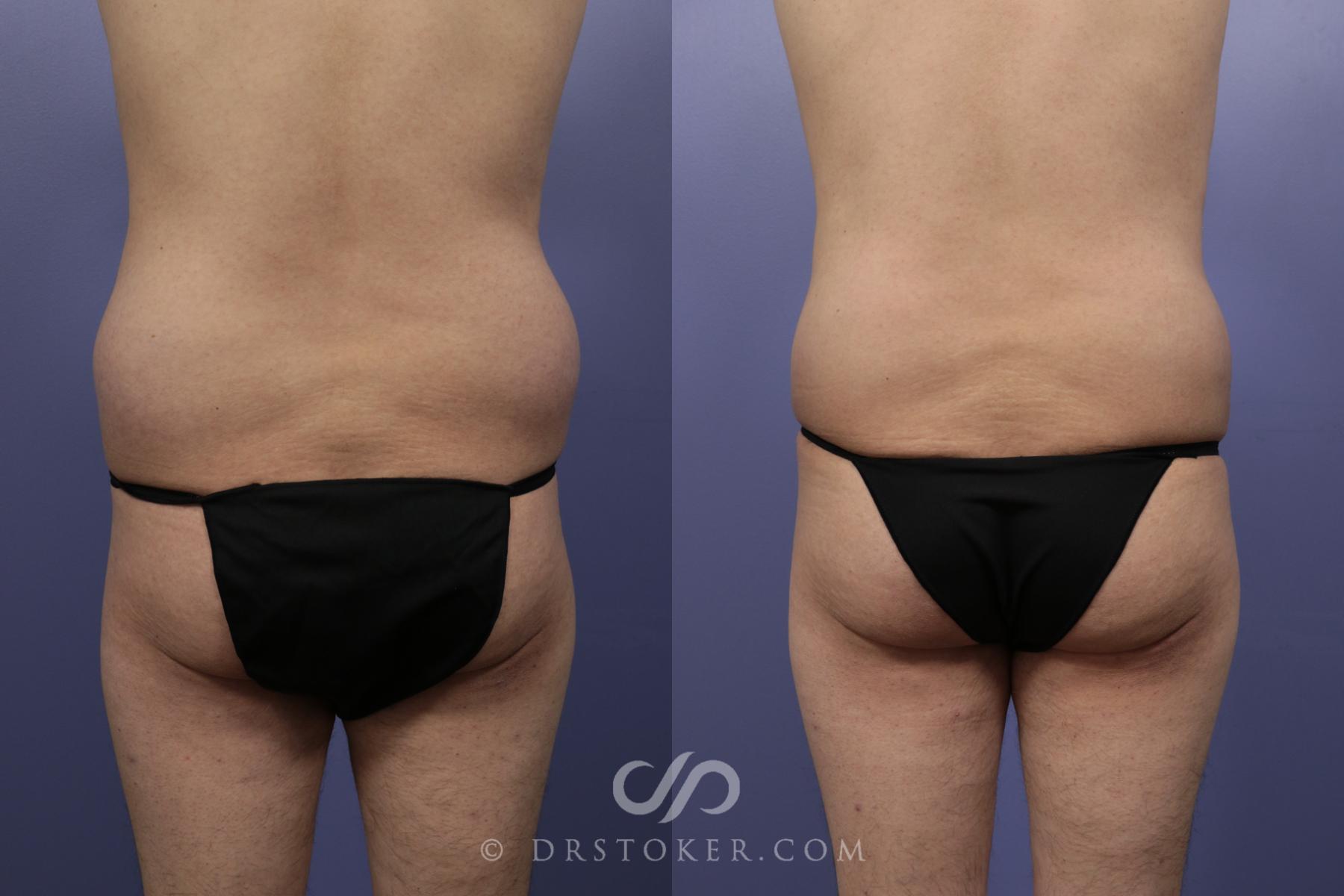 Before & After Liposuction Case 1084 View #1 View in Los Angeles, CA