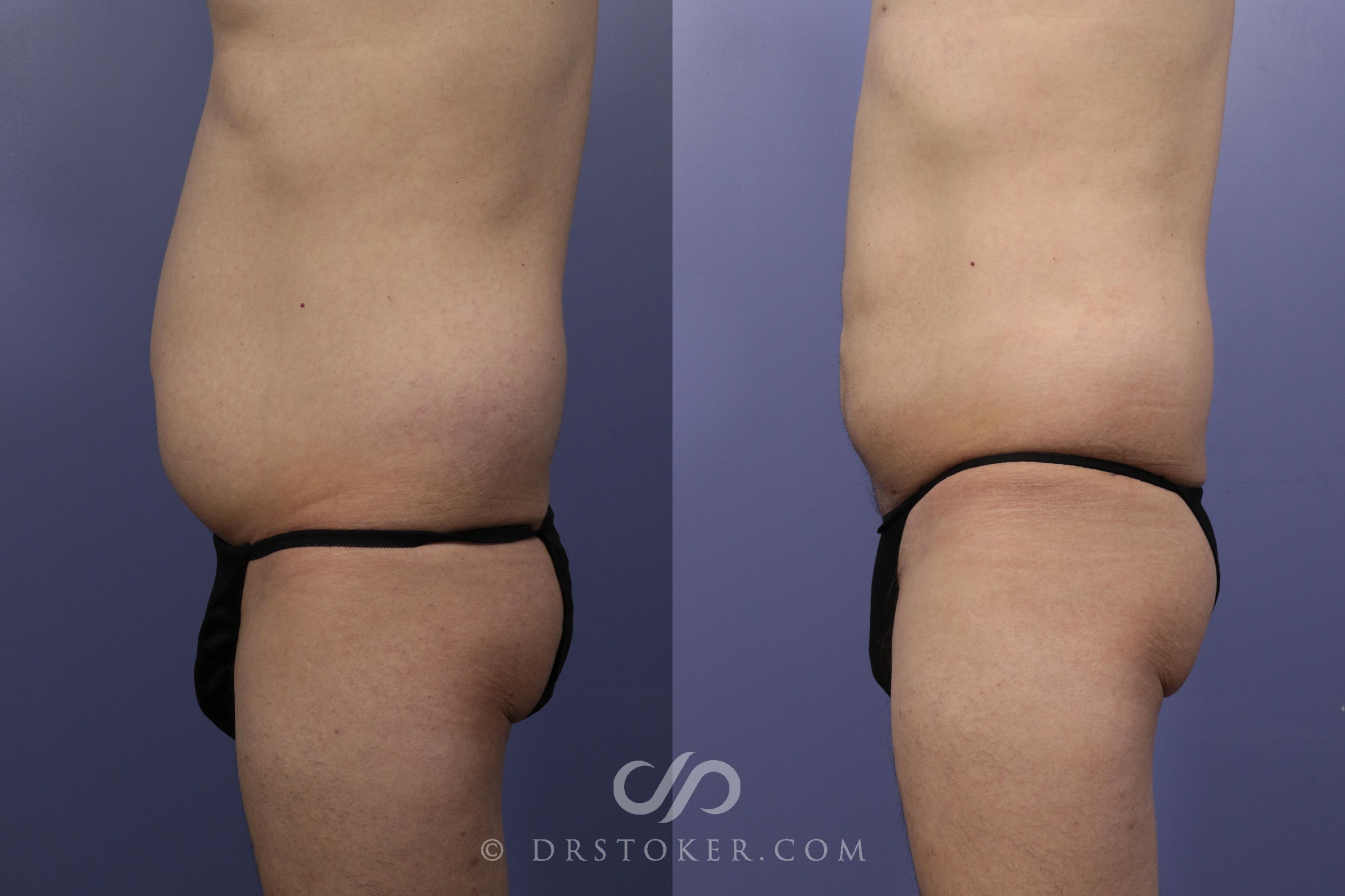 Before & After Liposuction Case 1084 View #2 View in Los Angeles, CA