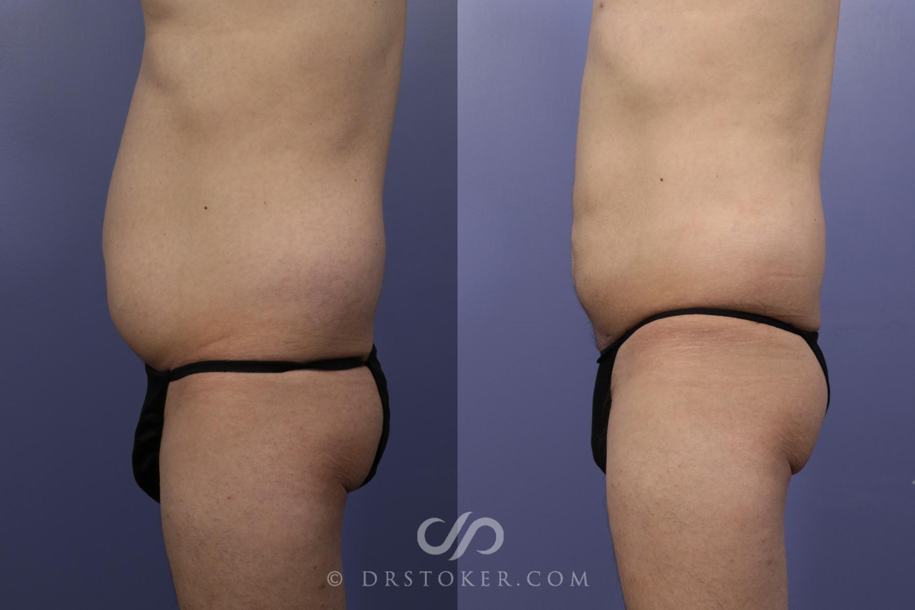Before & After Liposuction Case 1084 View #2 View in Los Angeles, CA