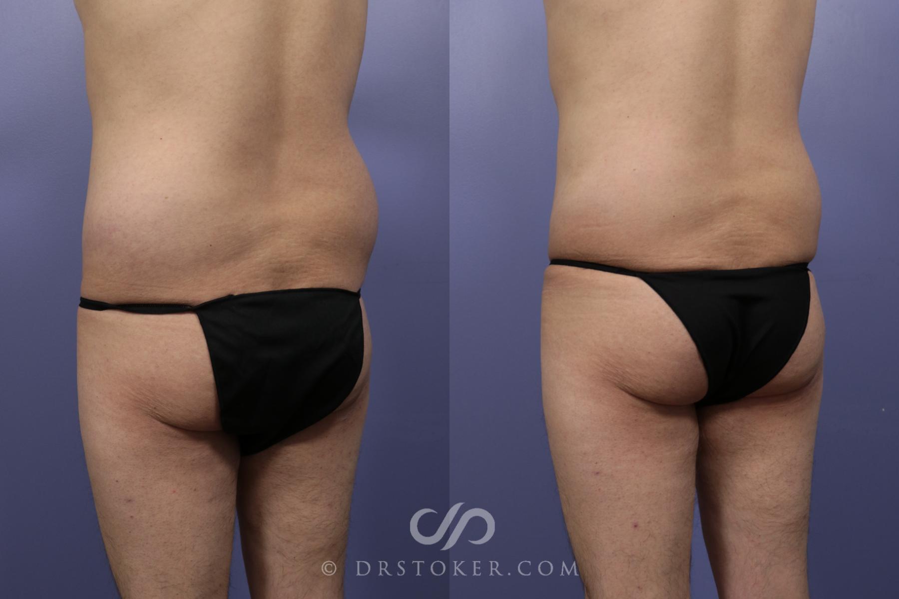 Before & After Liposuction Case 1084 View #3 View in Los Angeles, CA