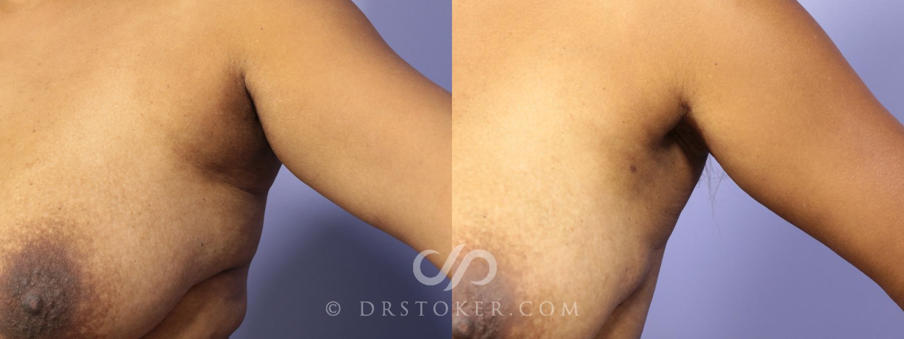 Before & After Liposuction Case 1085 View #2 View in Los Angeles, CA